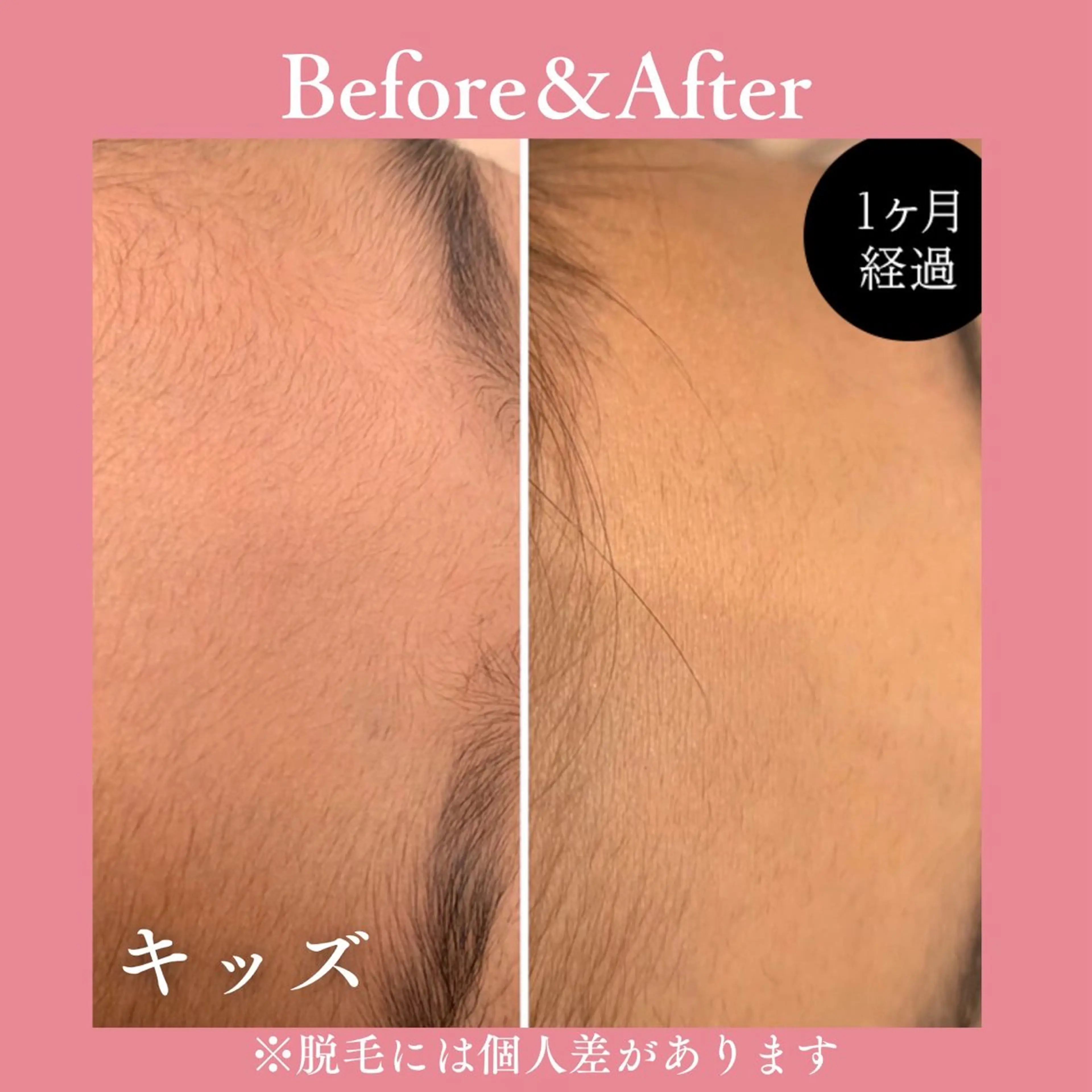 メンズ キッズ 有人型セルフサロン 脱毛/痩身/美顔のその他イメージ