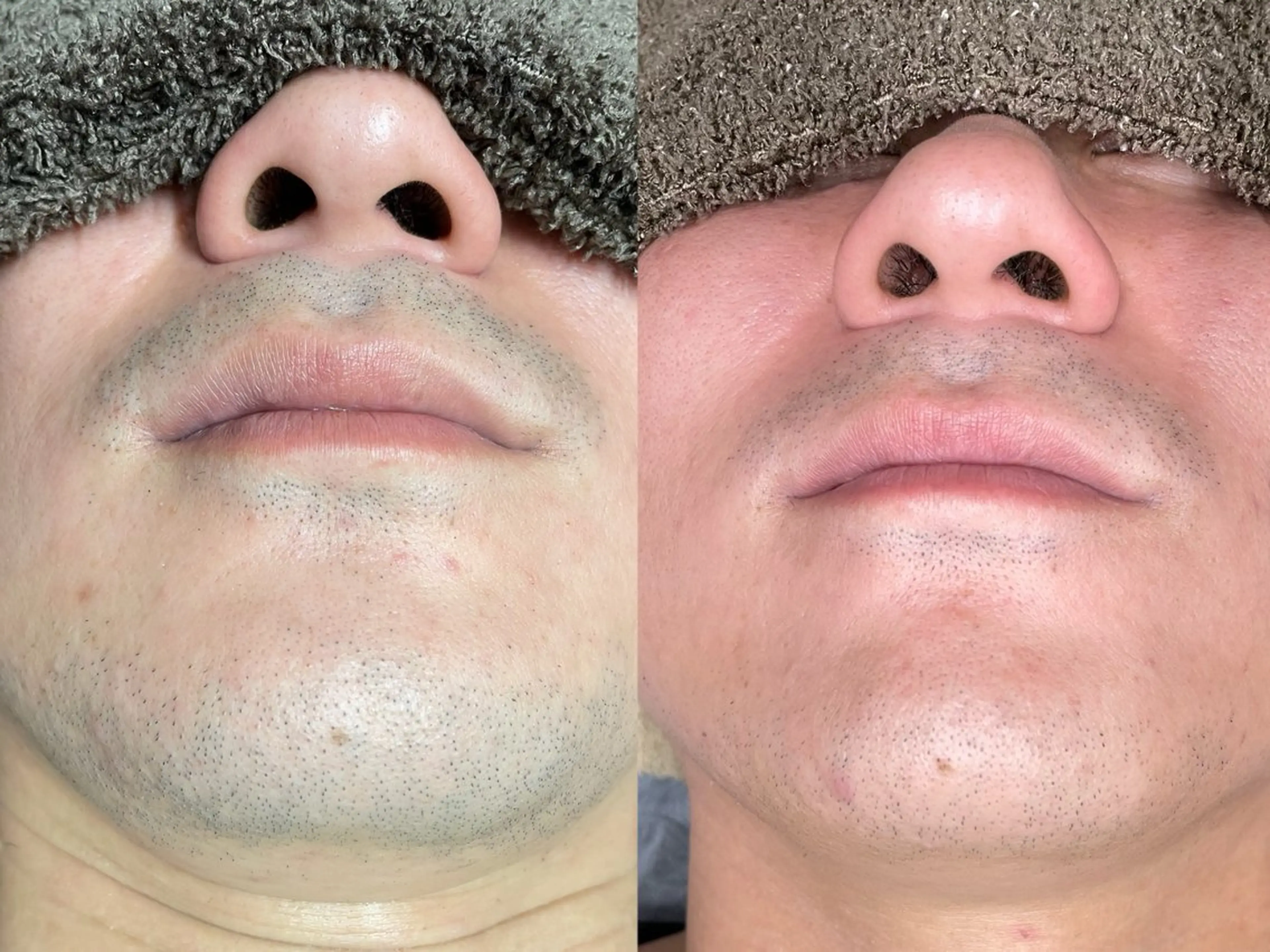 平日限定！ヒゲ脱毛の写真