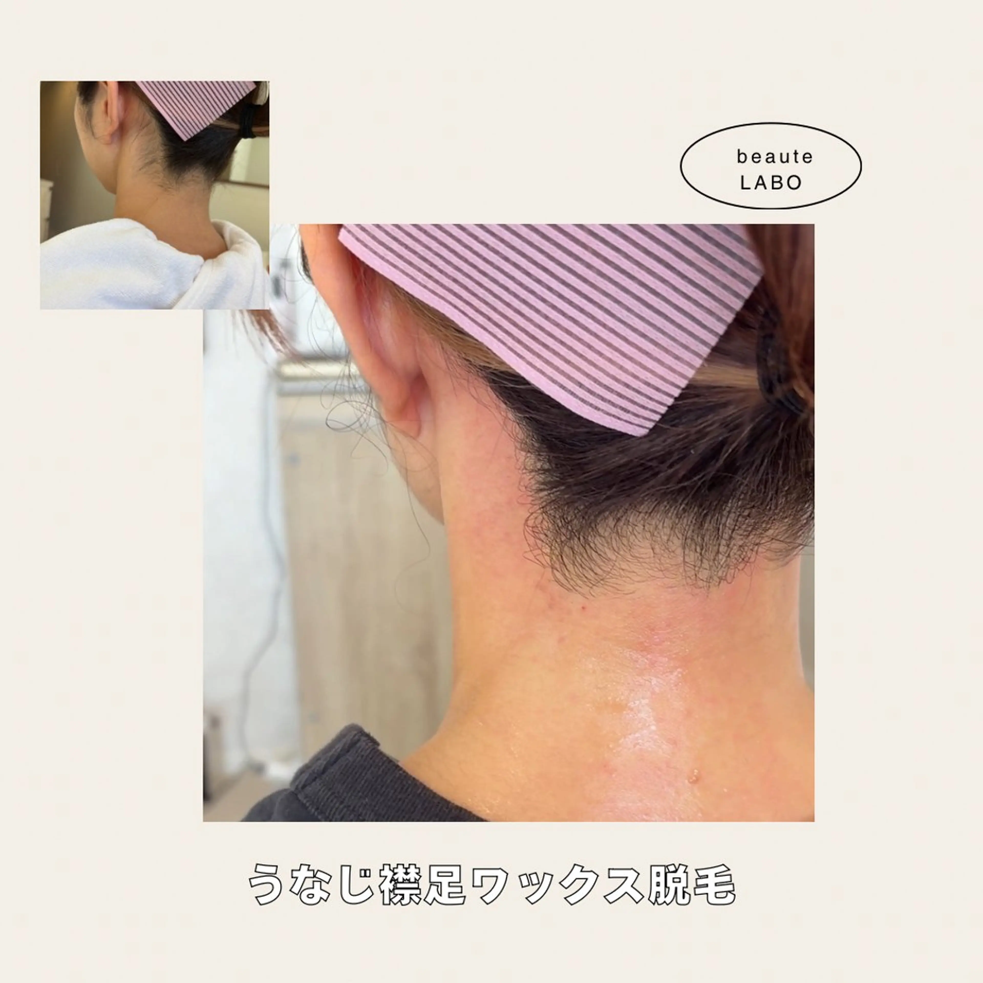 うなじ襟足ワックス脱毛【waxxxx使用】の写真