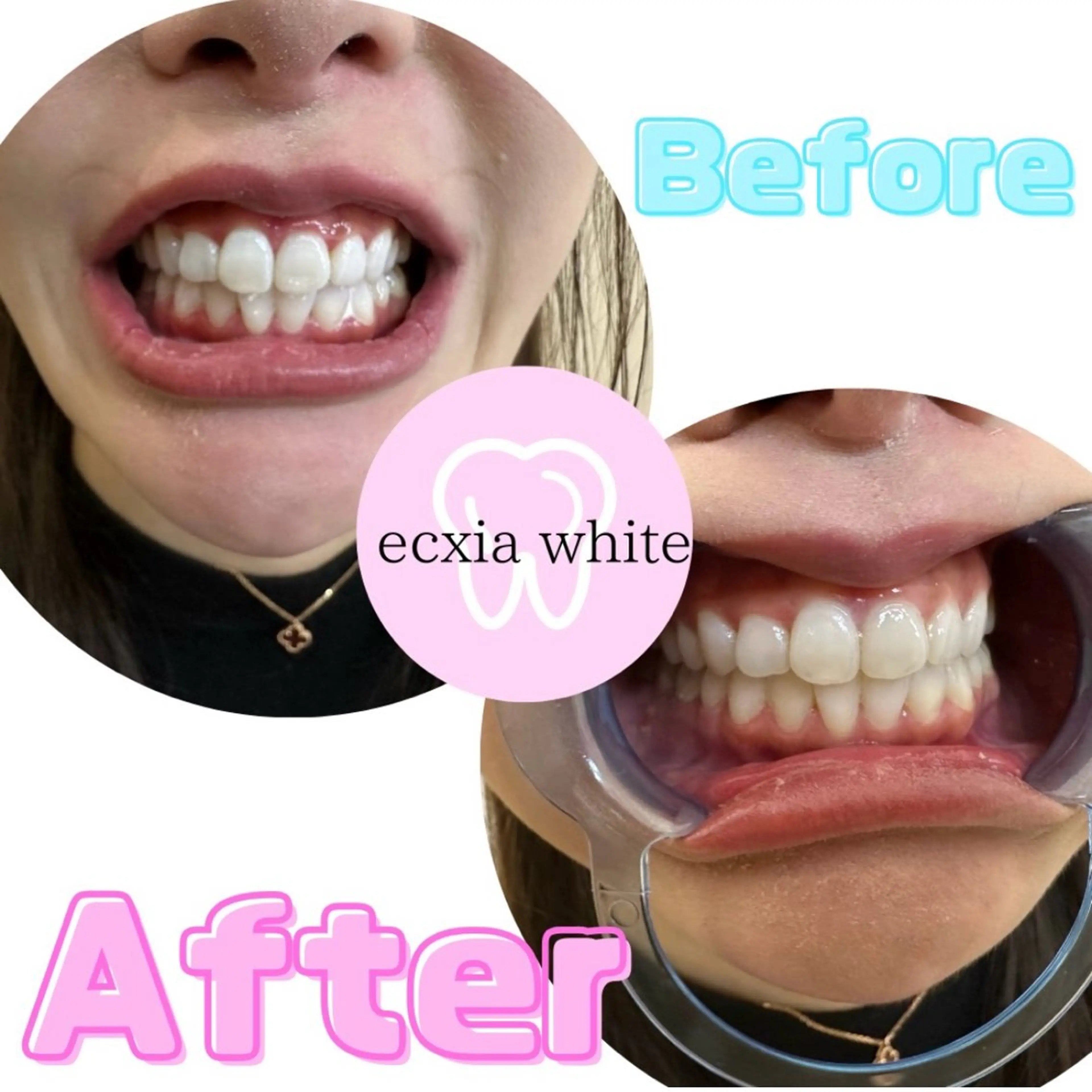 その他 エクシアホワイトニング前橋店所属・セルフホワイトニング エクシア前橋店のその他イメージ