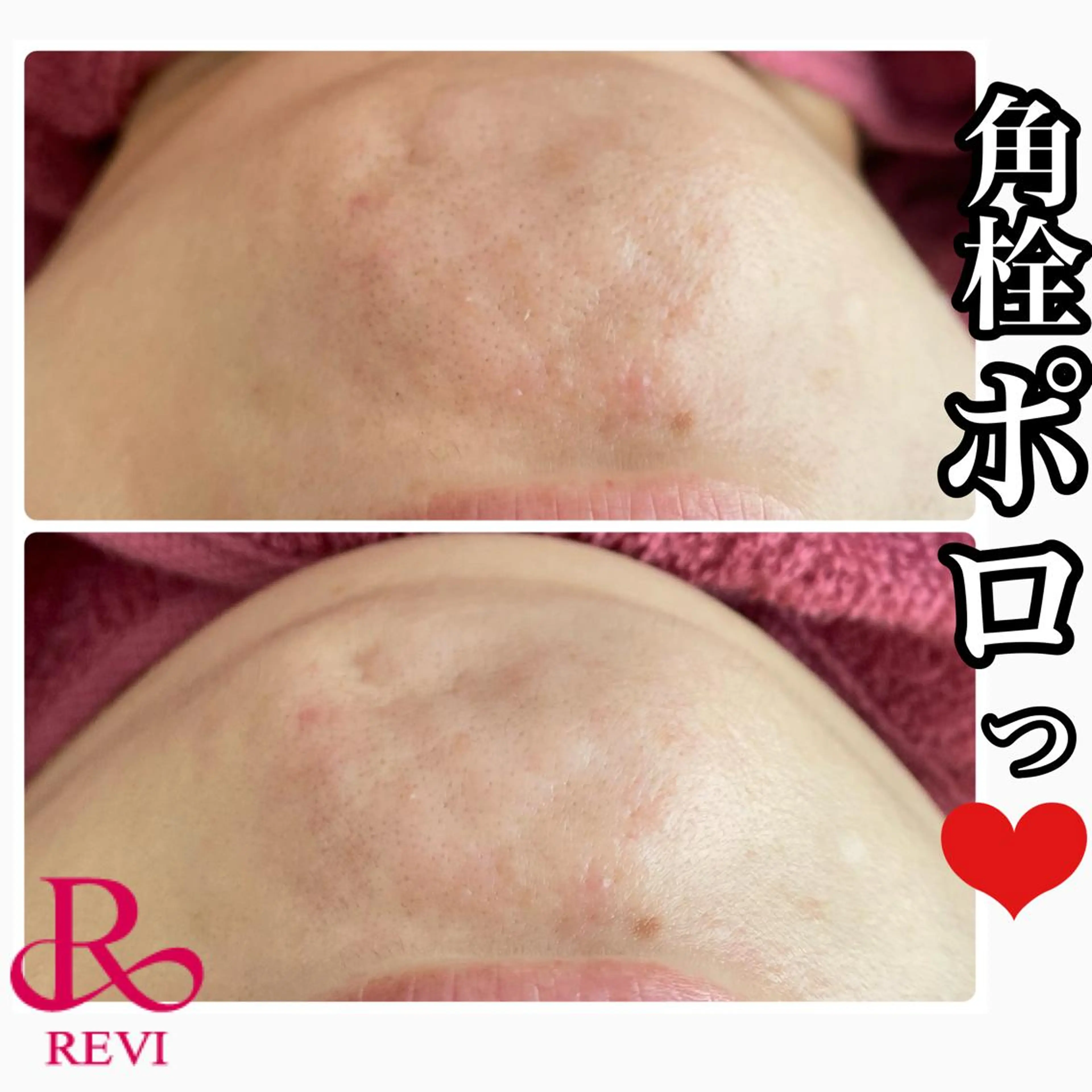 エステ Chalon所属・REVI取扱・肌悩み 毛穴Chalonのエステ・リラクイメージ