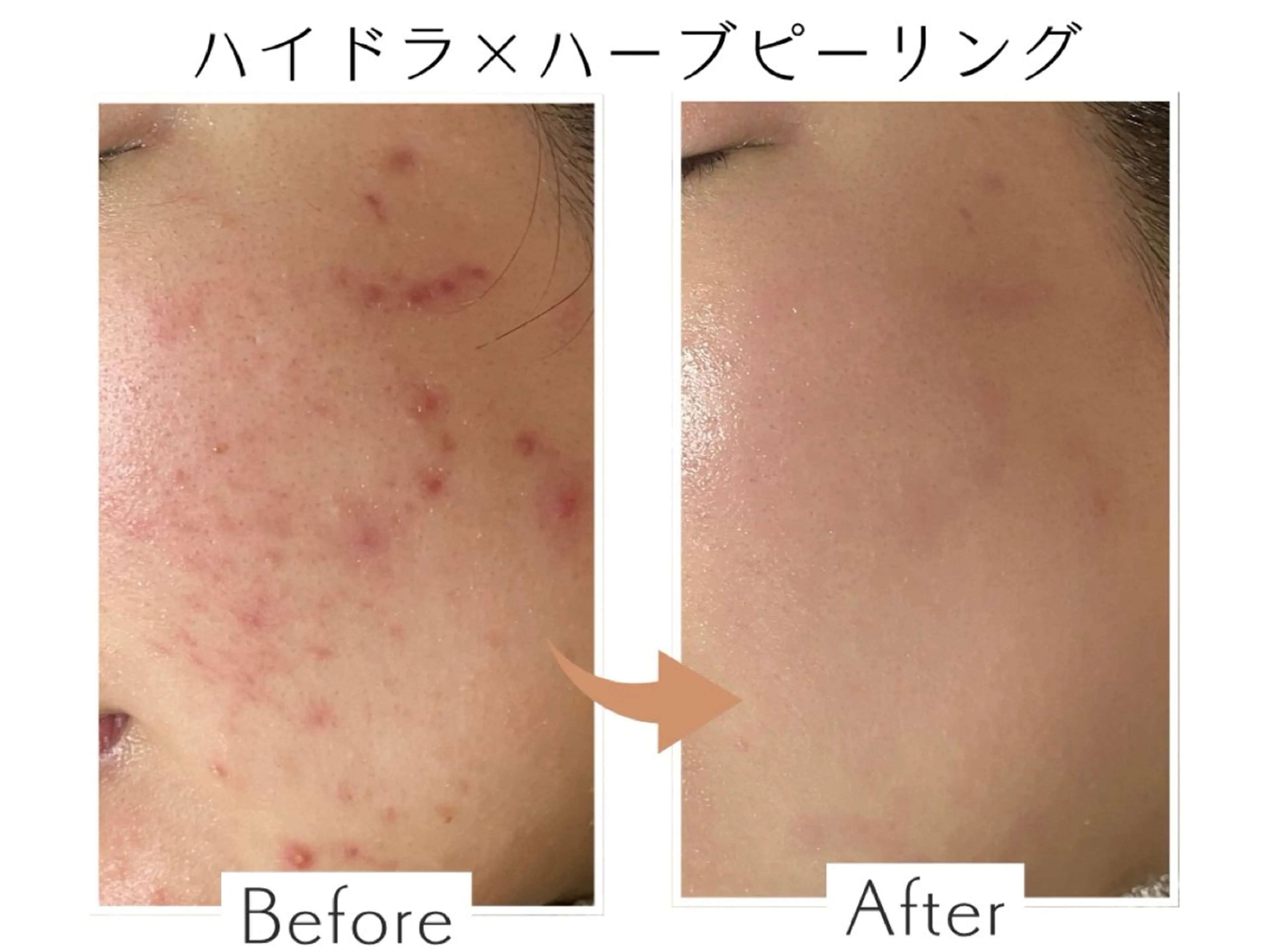 【リピート】水素ハイドラ×剥離なしハーブピーリング🌿🇰🇷の写真