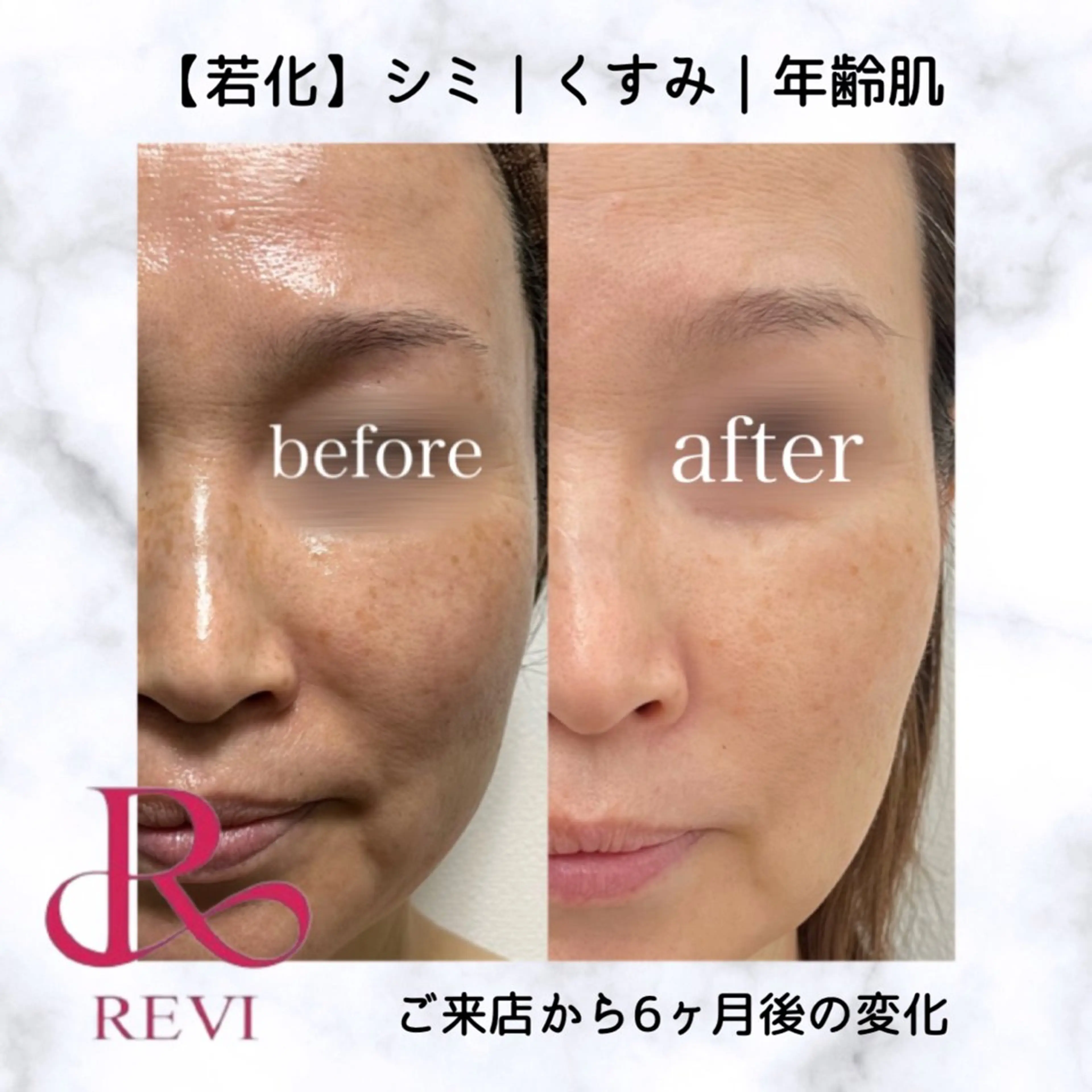 エステ REVIハーブピーリング/バストケア/脱毛 Retea.【ルテア】所属・肌質改善|ニキビ| 毛穴|Retea.のエステ・リラクイメージ