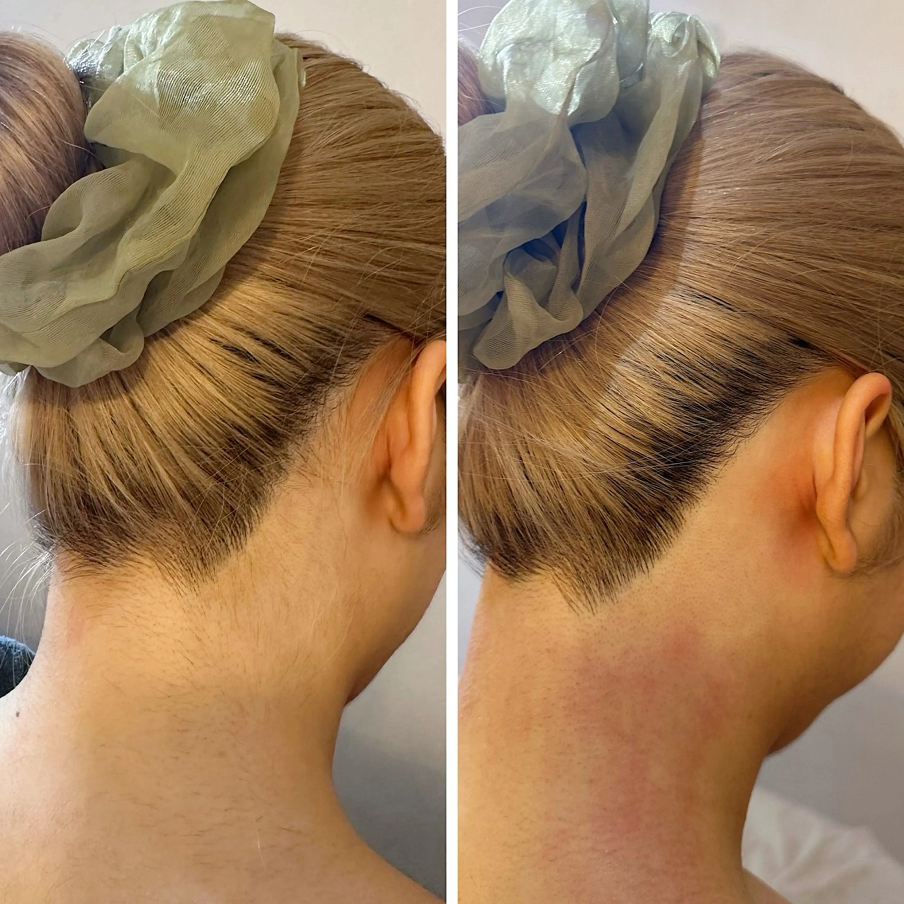 脱毛 うなじ脱毛/美肌脱毛 LABELのエステ・リラクイメージ