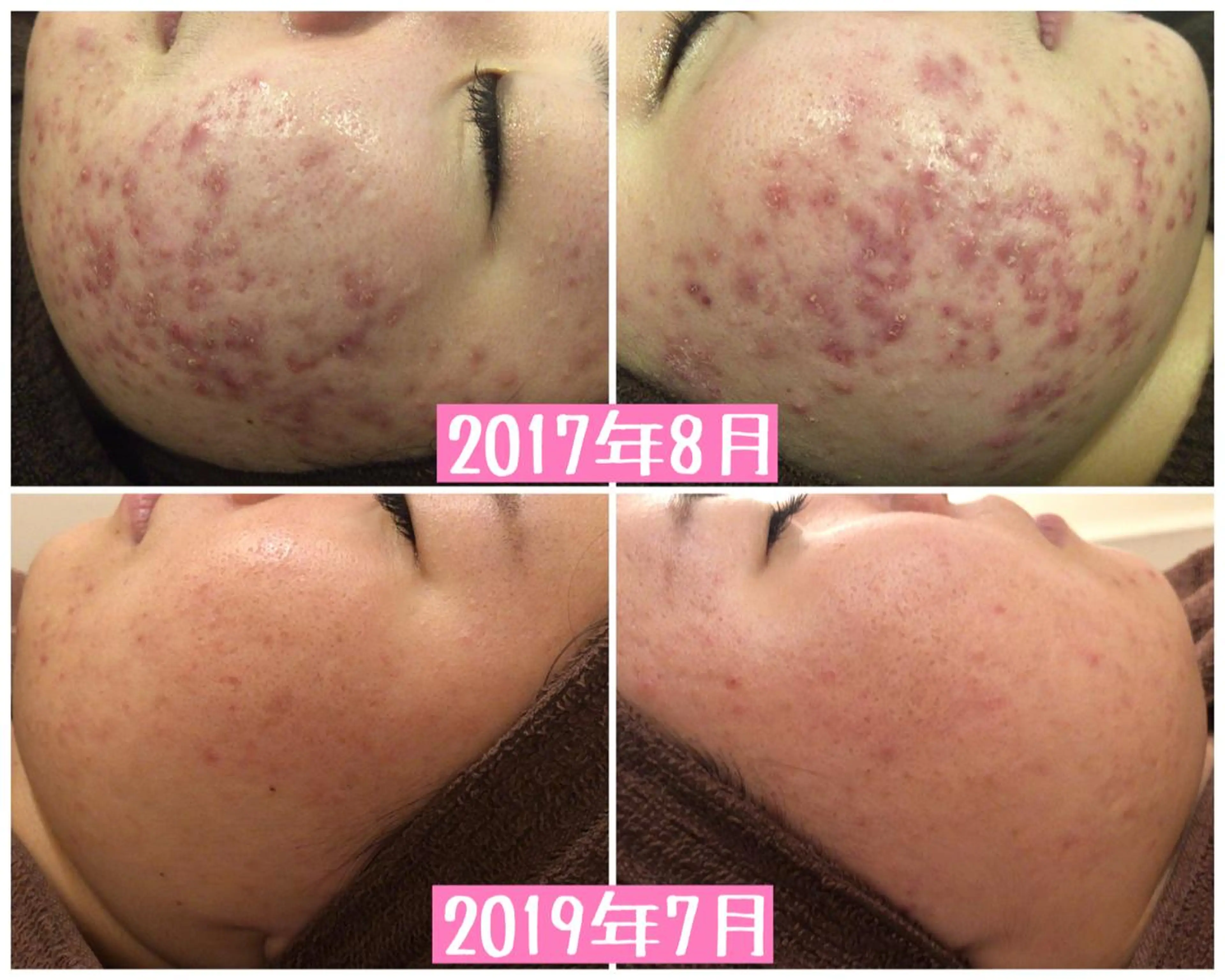 ミディアム カラー パーマ ヘアアレンジ メンズ キッズ ネイル マツエク・マツパ エステ リラク アクール　齋藤 ♡肌トラブル卒業のエステ・リラクイメージ