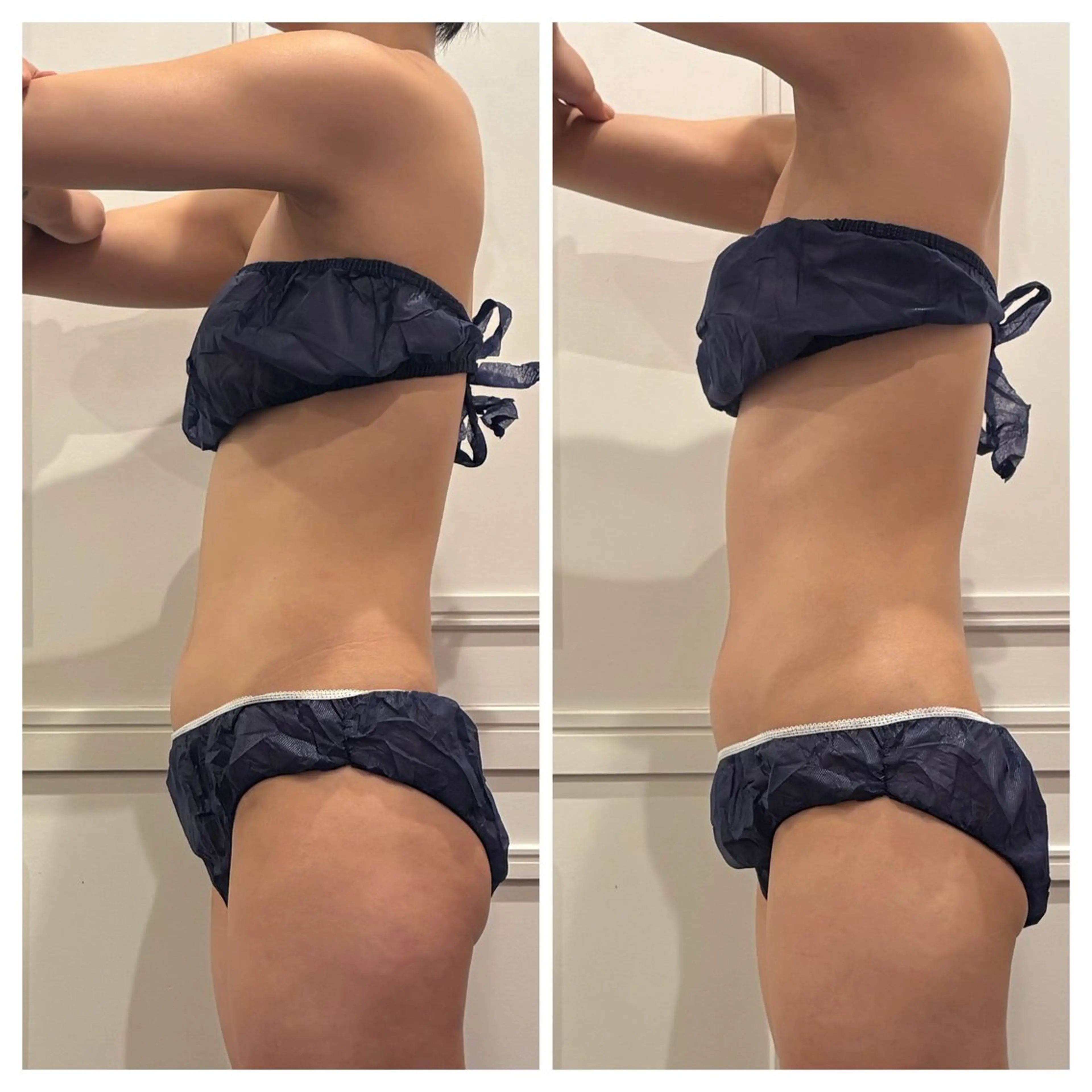 👙【お腹・腰集中】ハイパーナイフEX✖️マッサージの写真
