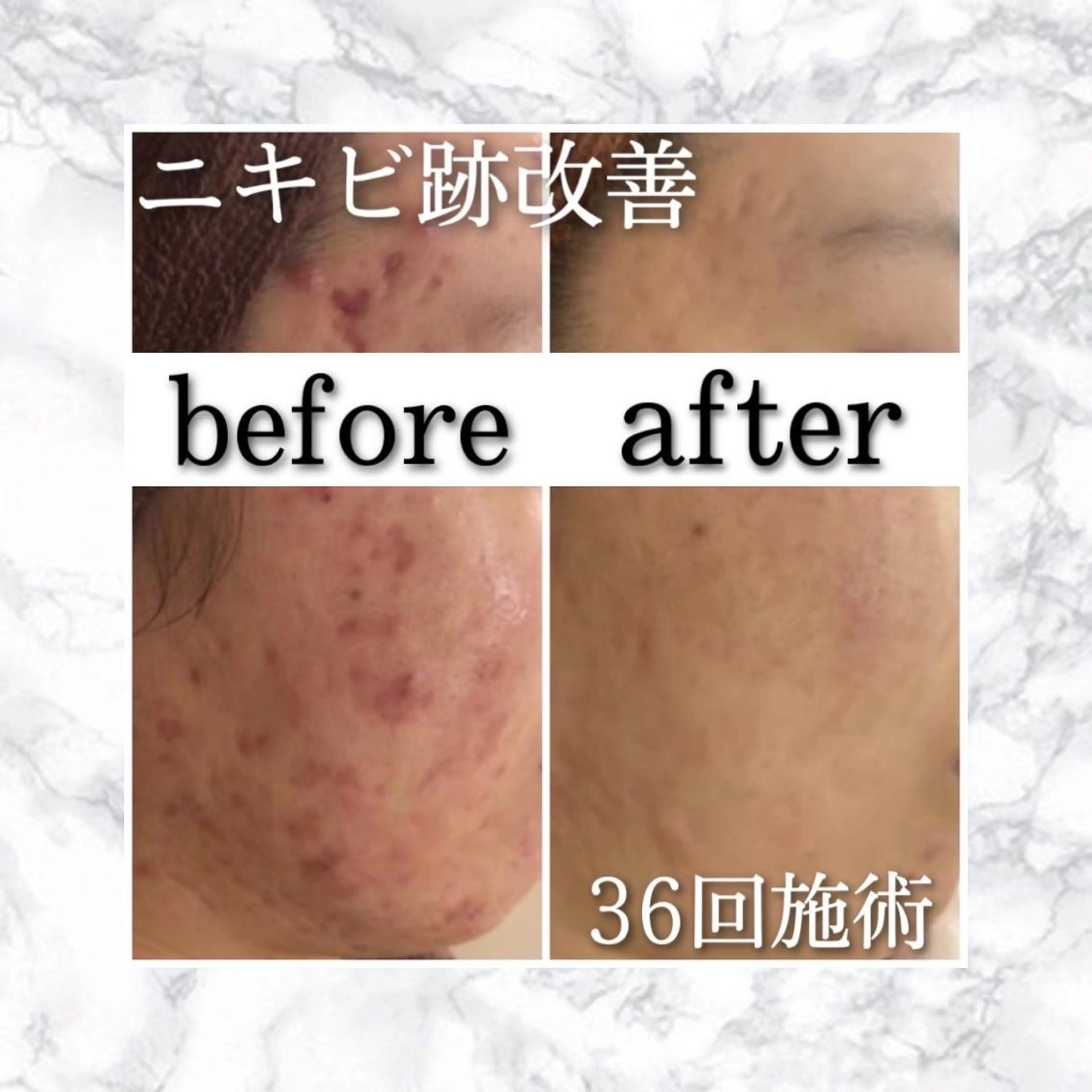 セミロング カラー パーマ ヘアアレンジ メンズ キッズ ネイル マツエク・マツパ アイブロウ エステ リラク ニキビ特化型エステ 🍋最短で肌質改善のエステ・リラクイメージ