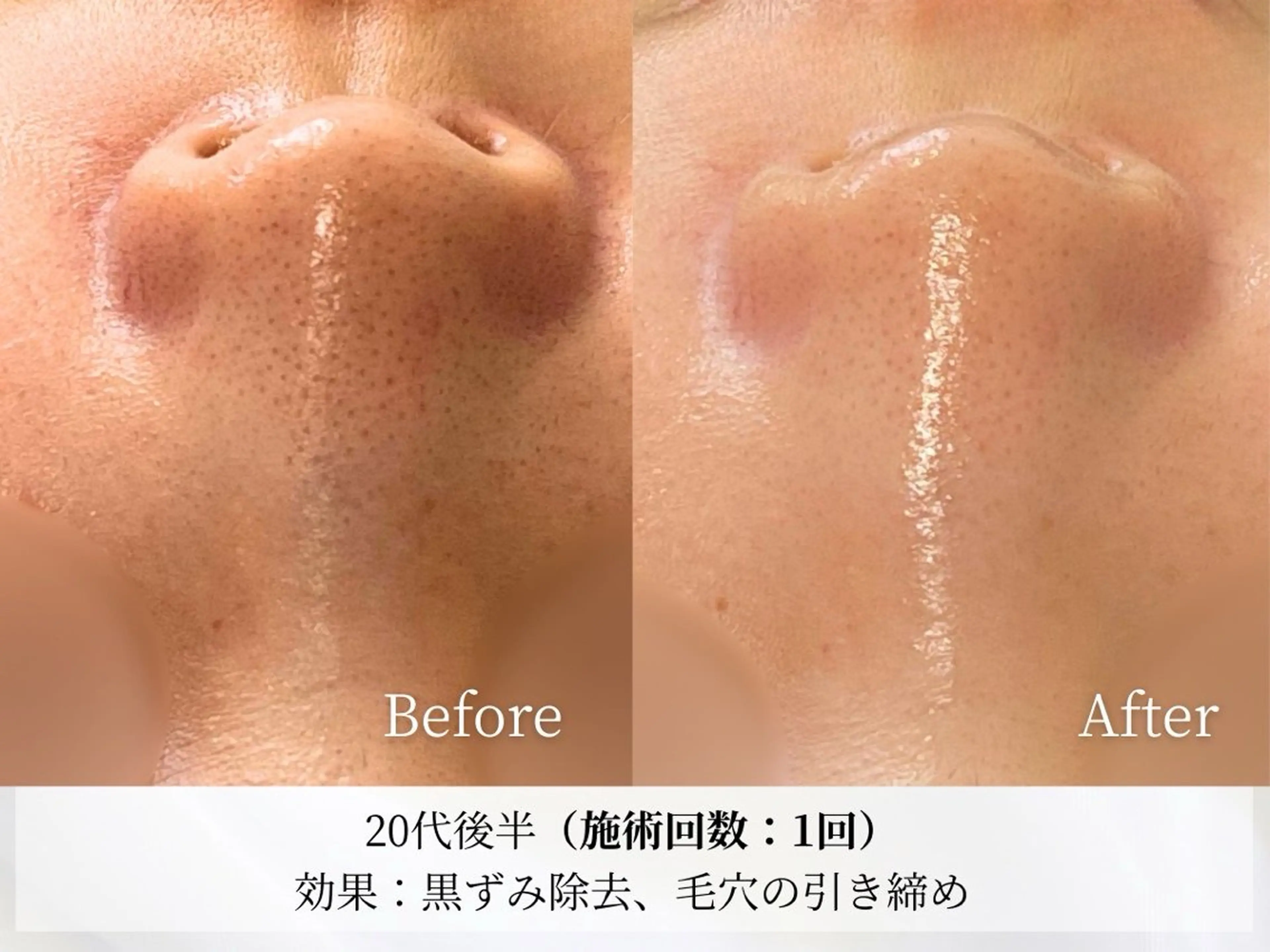 NEWオープン特別《毛穴洗浄+毛穴吸引》気になる鼻の毛穴ごっそりとれる!ザラつき鼻さようなら✨️酵素洗顔付きの写真