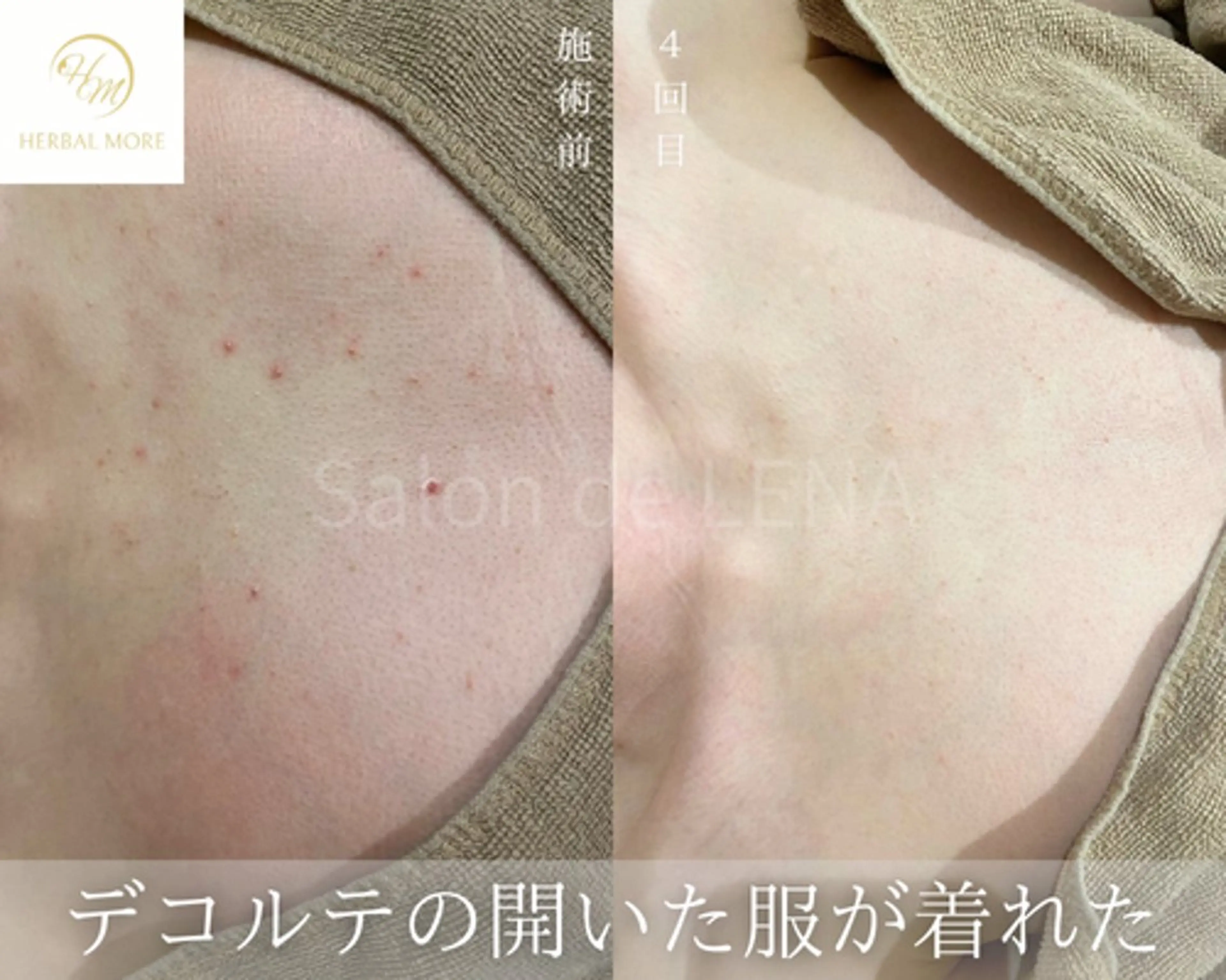 【デコルテ◆35歳​〜​59歳限定】剥離ありハーブピーリングの写真