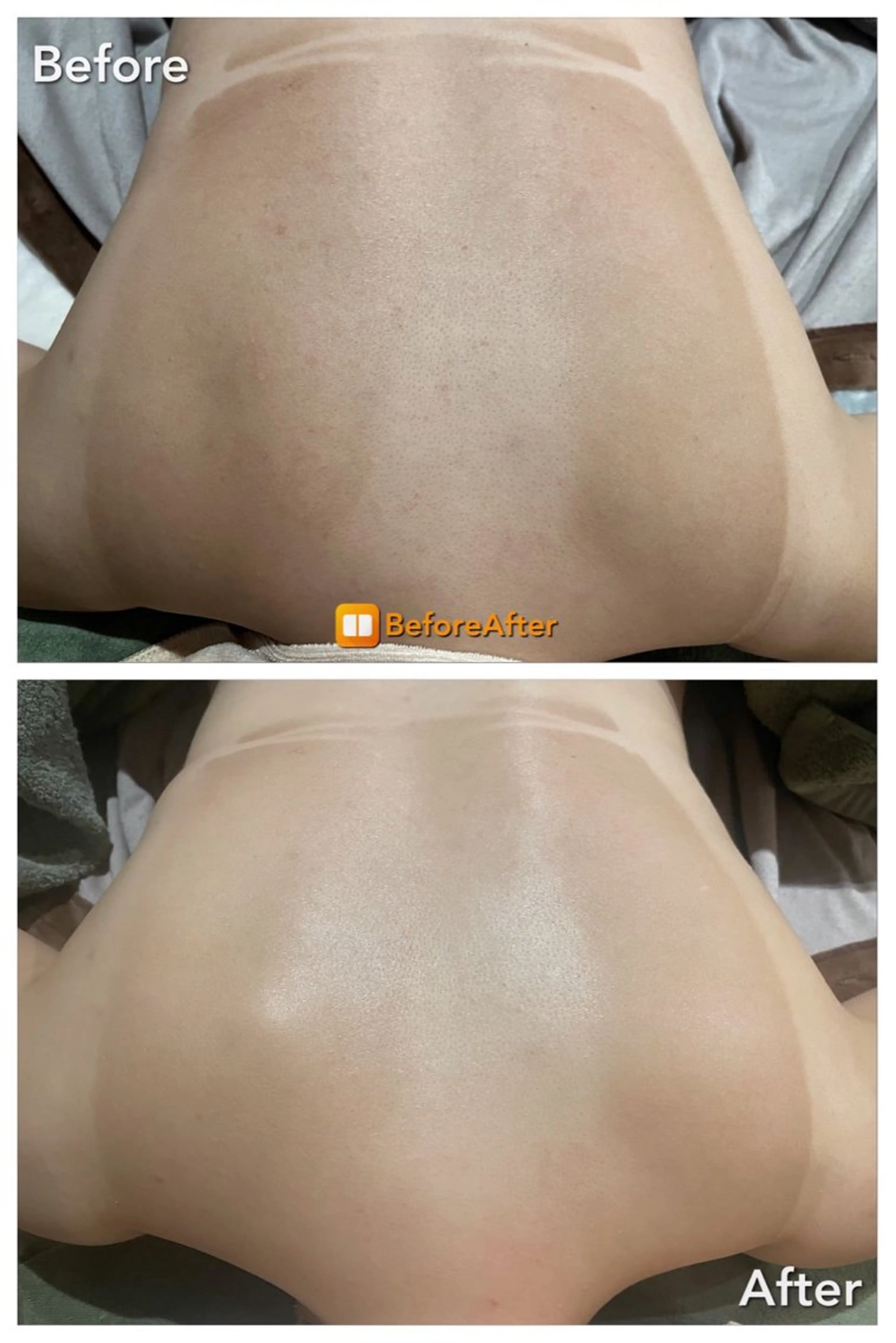 エステ Meupニキビ専門店 背中/ハーブ/ララのその他イメージ