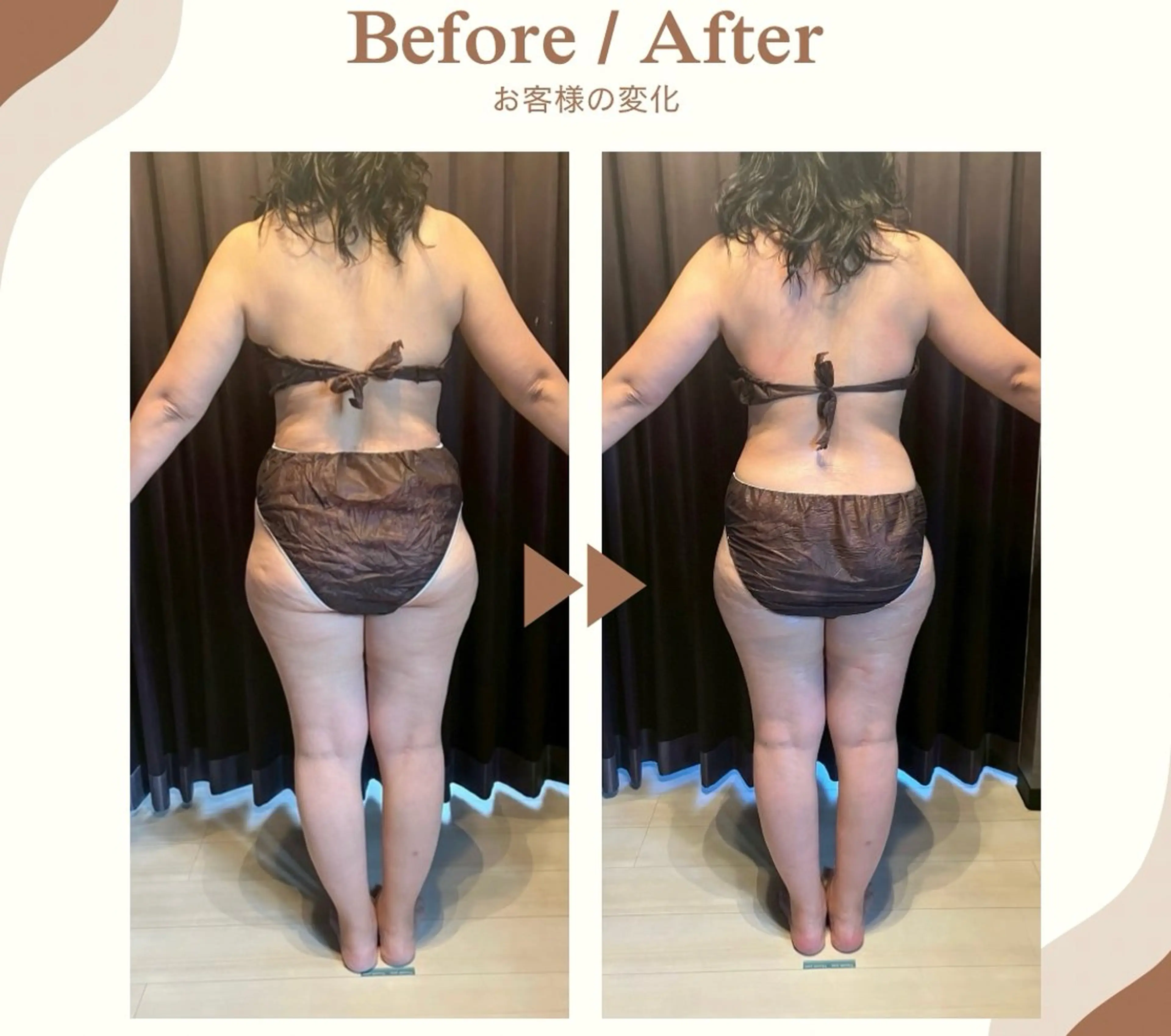 ◎12月限定/た​〜​っぷり120分！凸凹脂肪もパンパン浮腫みもさようなら👋ゴリッゴリ強めエステの写真