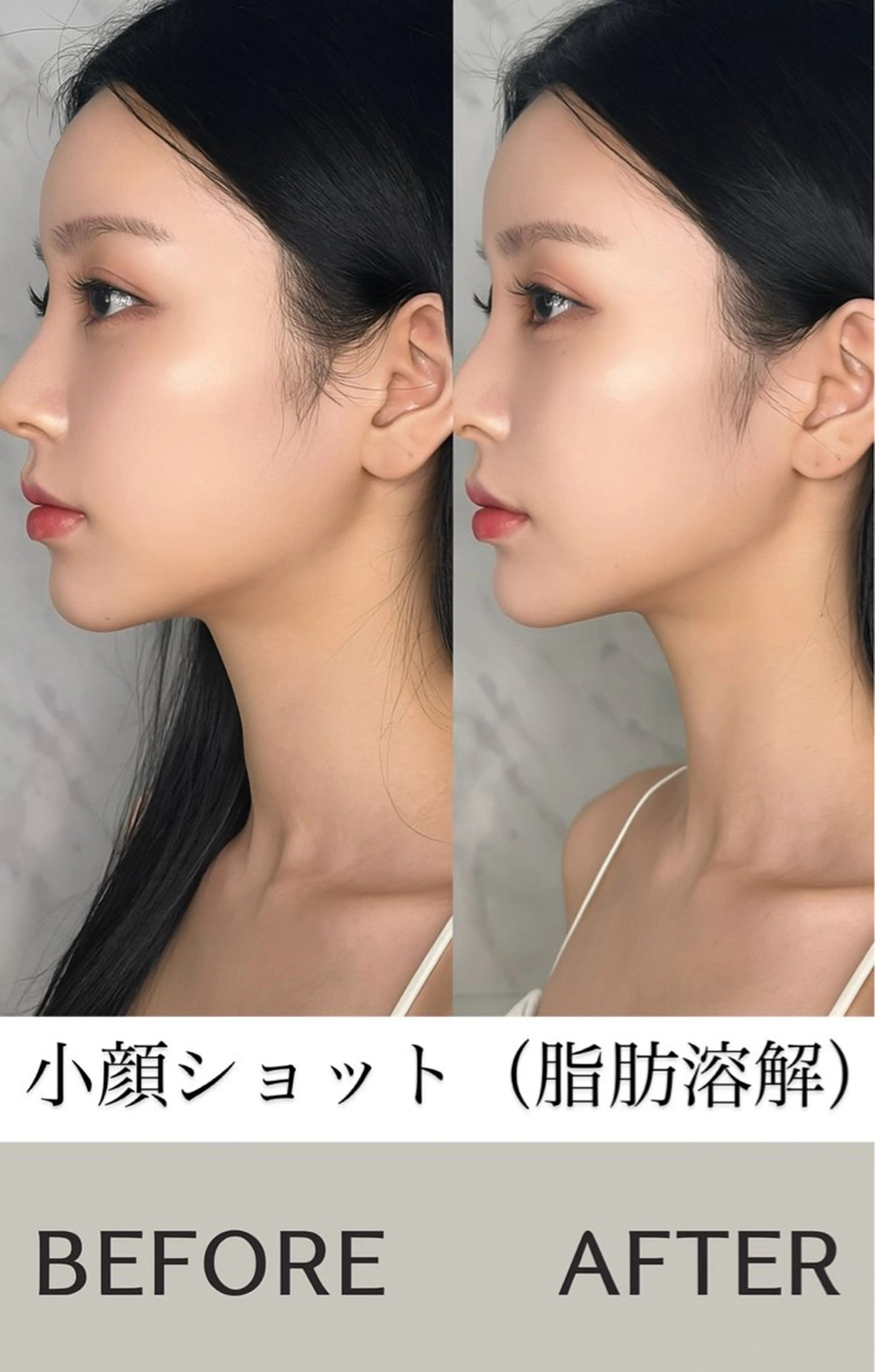 【二重顎を解消◎速攻小顔】脂肪に直接アプローチ！痛みなしでスッキリ小顔へ。リフトアップ効果も◎最新の小顔施術です！の写真