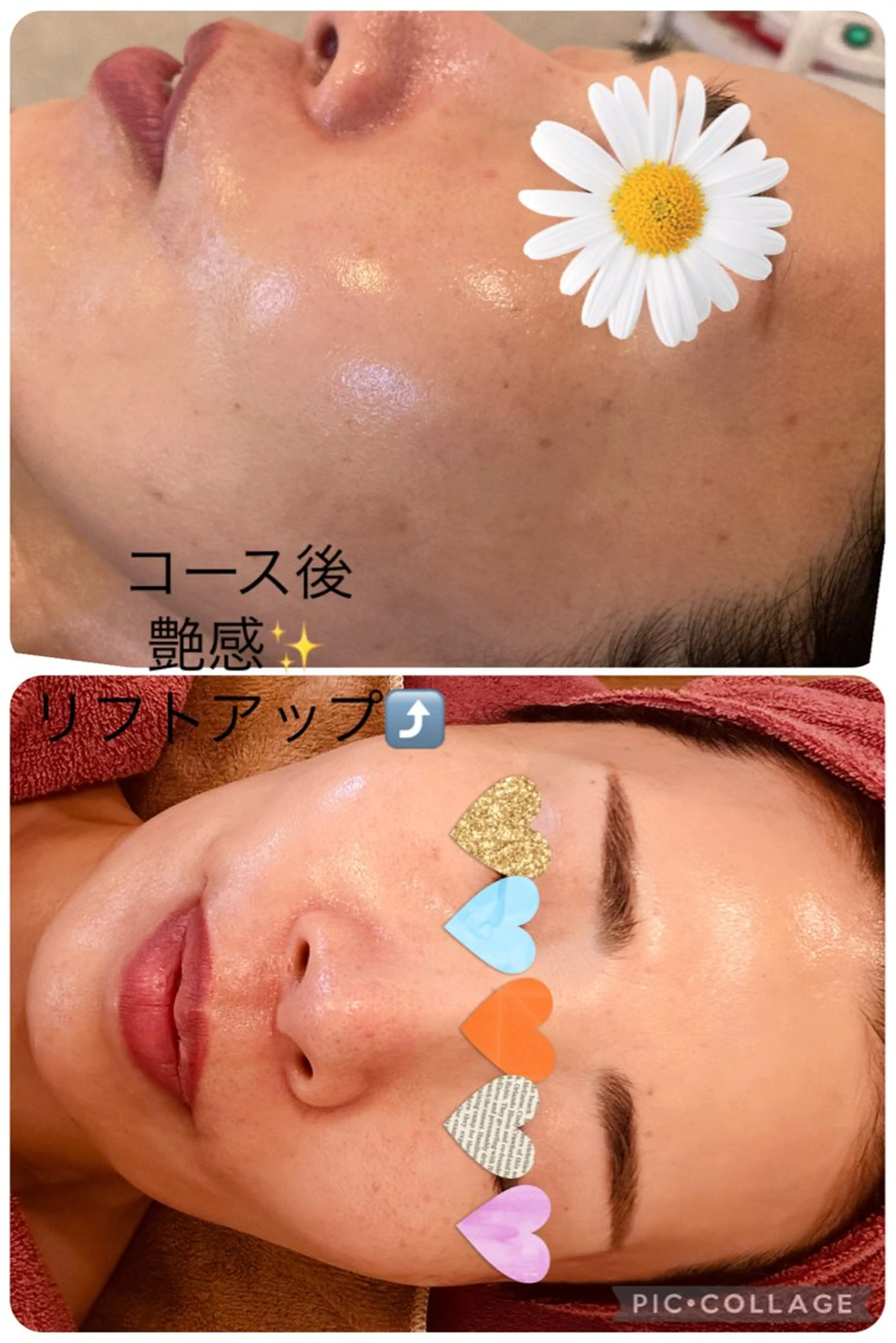 夏の肌疲れ、日焼け、ごわつく肌に✨【フラワーハーブピーリング🌿＋カクテル美容液ポレーション導入】透明感up.艶肌、卵肌の写真