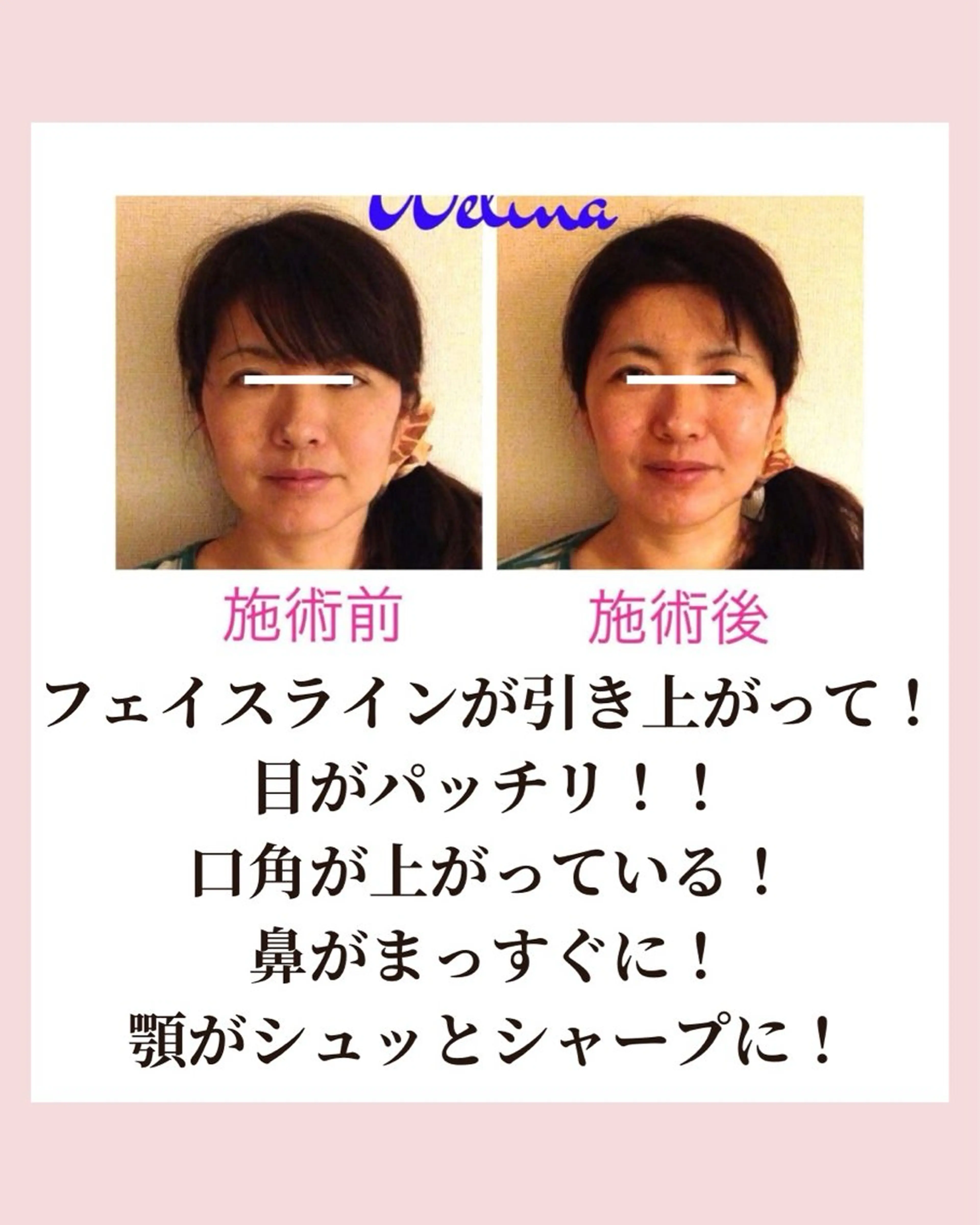 痩身・小顔・骨盤矯正×ヒップアップ専門エステ Peach所属・桃尻つかさ🍑小顔× ノーファンデ肌作りのエステ・リラクイメージ