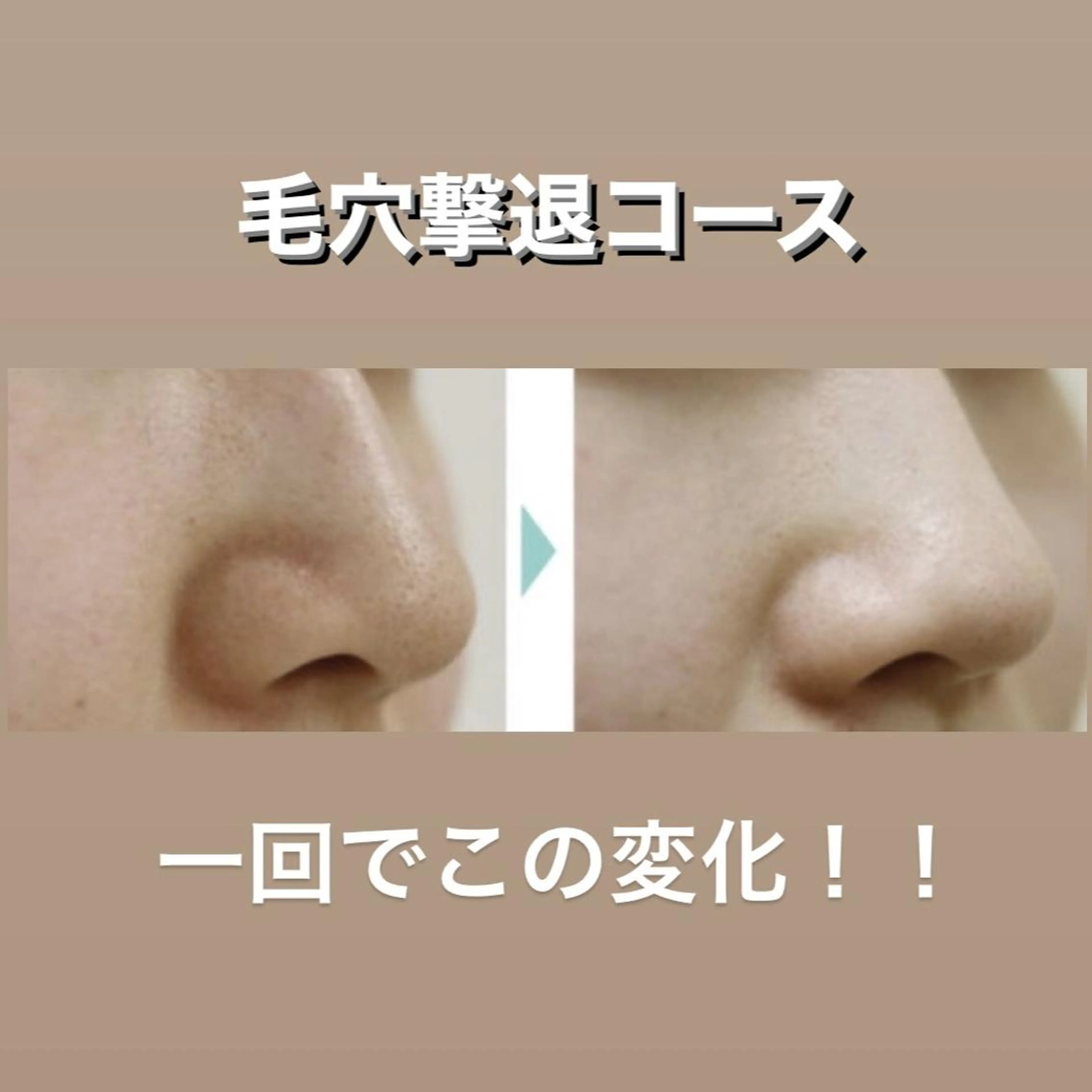 長年の小鼻黒ずみ『ブラックヘッド』でお悩みの方におススメ☆毛穴角質ケア＆毛穴吸着パック☆デコルテ・ヘッドマッサージ付きの写真