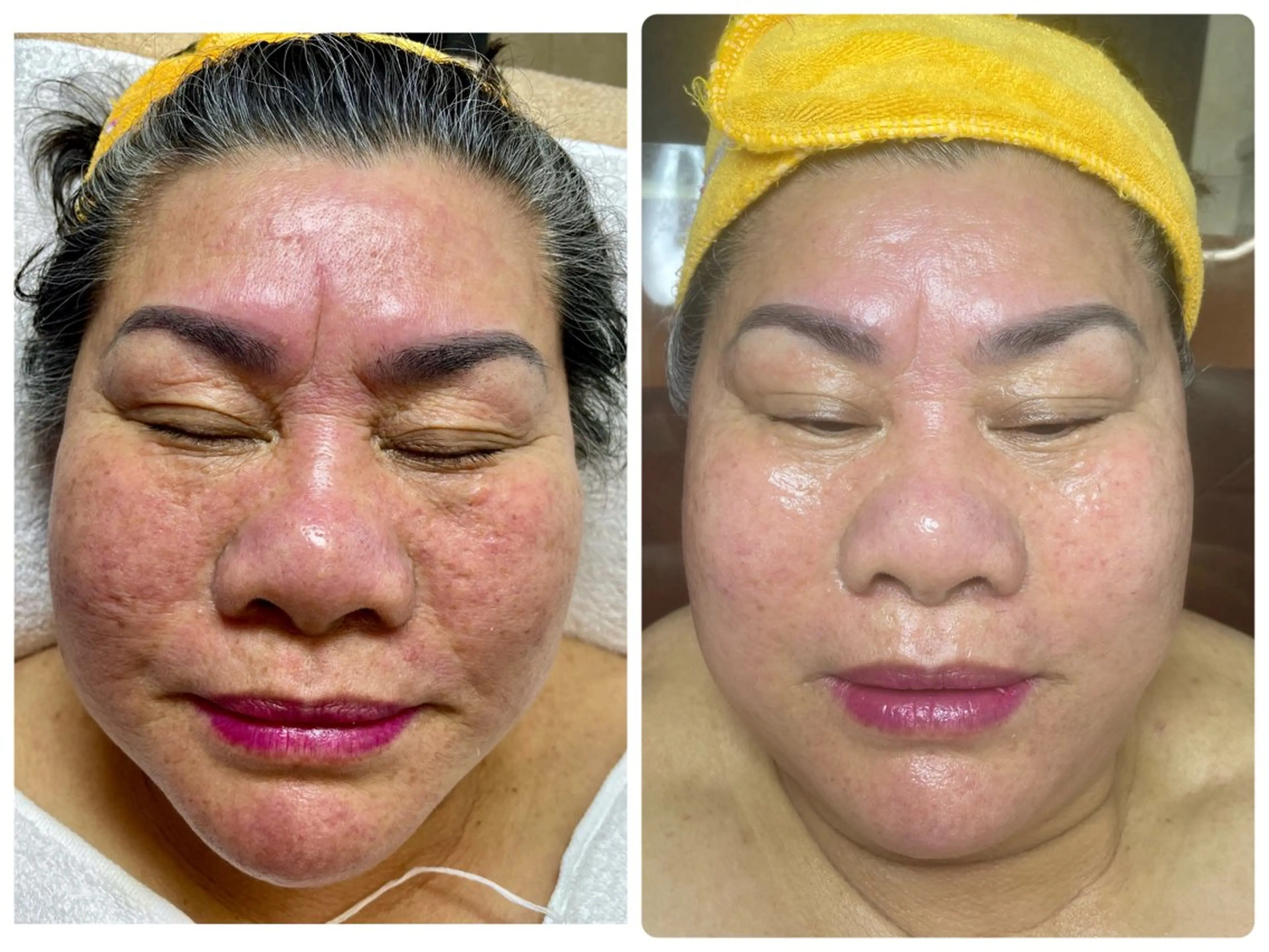 ニキビ、痩身、脱毛、 サクラチャンスパのエステ・リラクイメージ