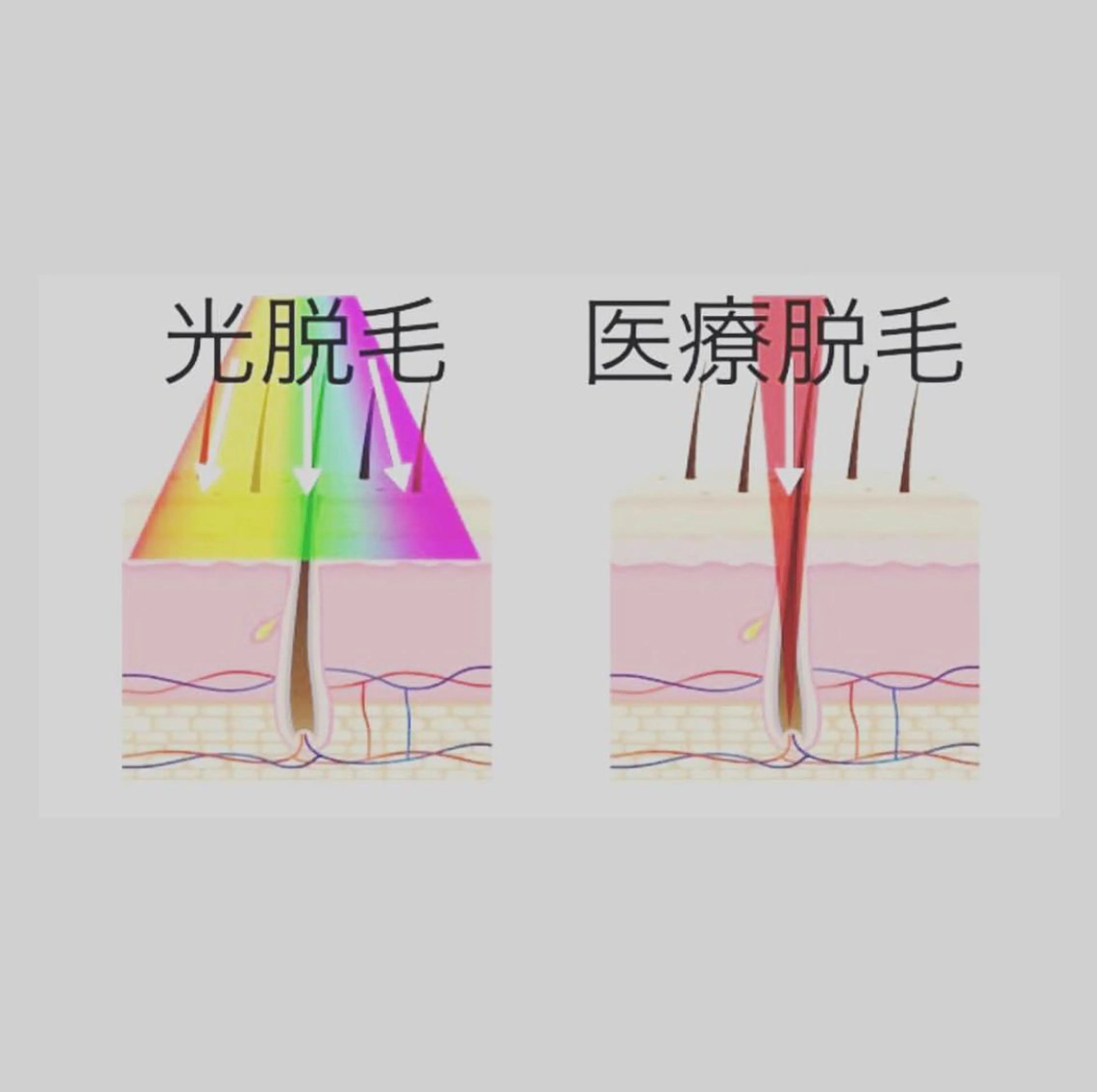 脱毛 都度払い脱毛⭐️ 脱毛サロンMIRACのエステ・リラクイメージ