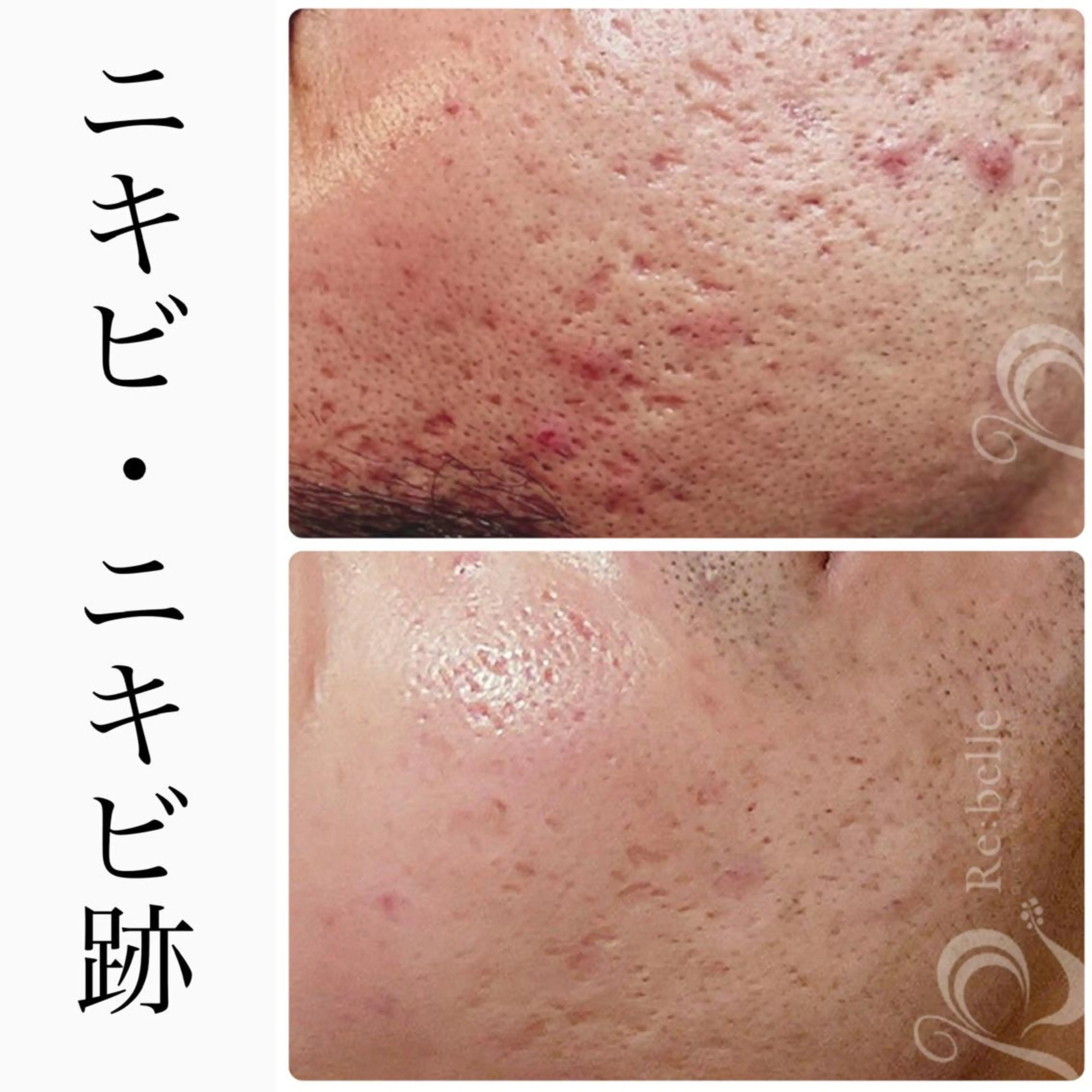 BeSkin藤沢店所属・ニキビ/肌質改善 BeSkin 藤沢店のエステ・リラクイメージ