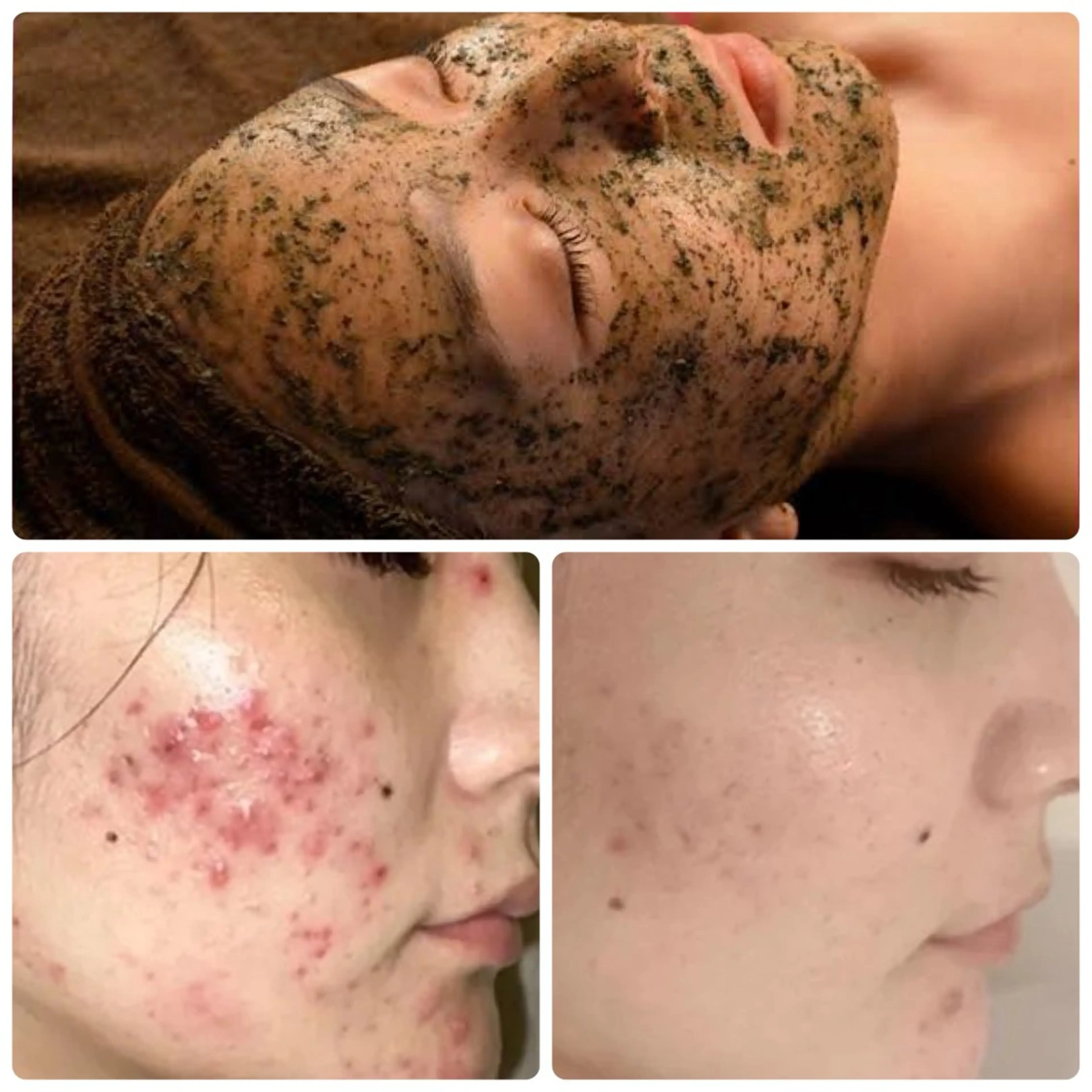 【本気の肌質改善】💋ハーブピーリング 🌿ヒト幹細胞パック付き¥10,000の写真