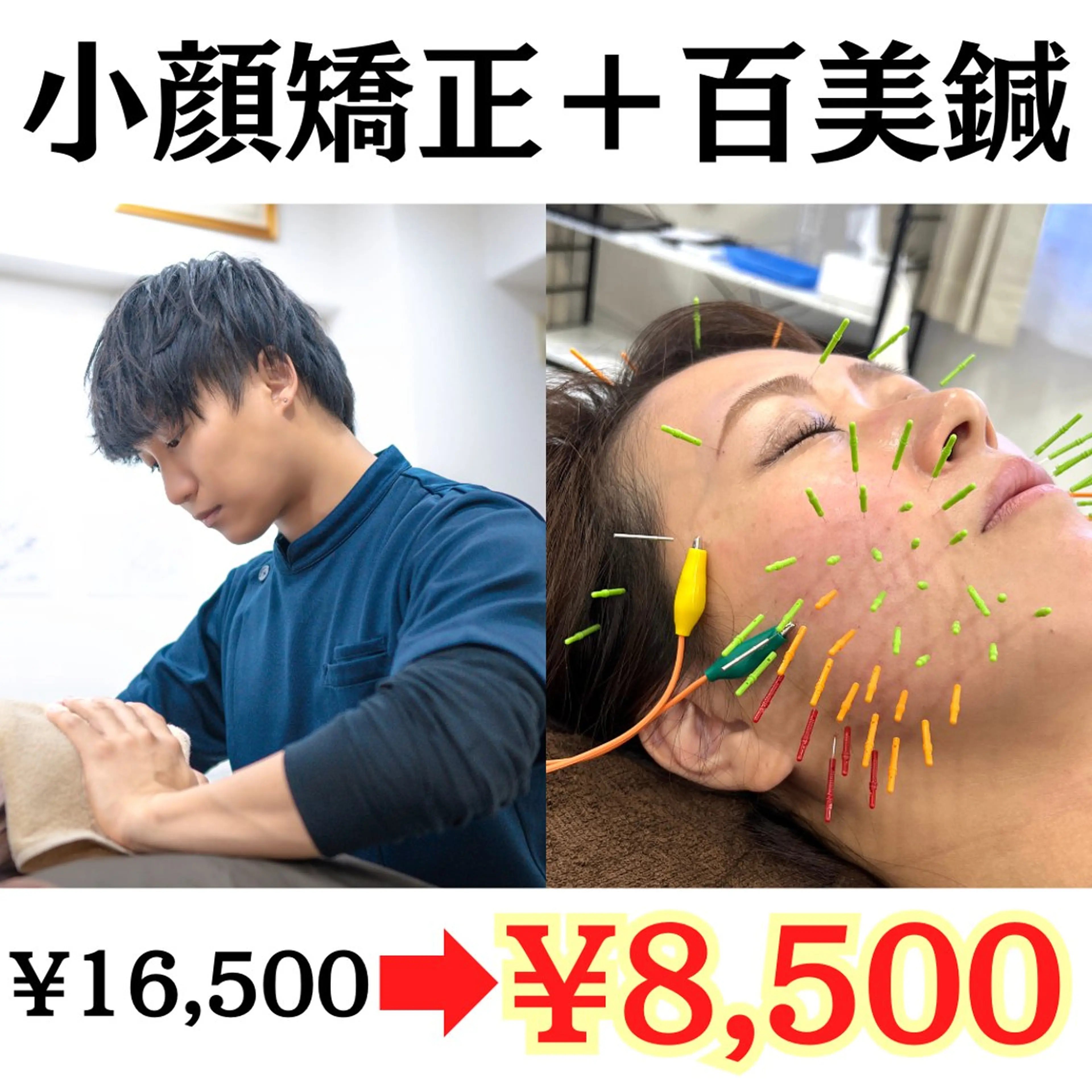 【Summerクーポン】百美鍼+小顔矯正（80分）(電気鍼 ドライヘットスパ ヘッドマッサージ)の写真