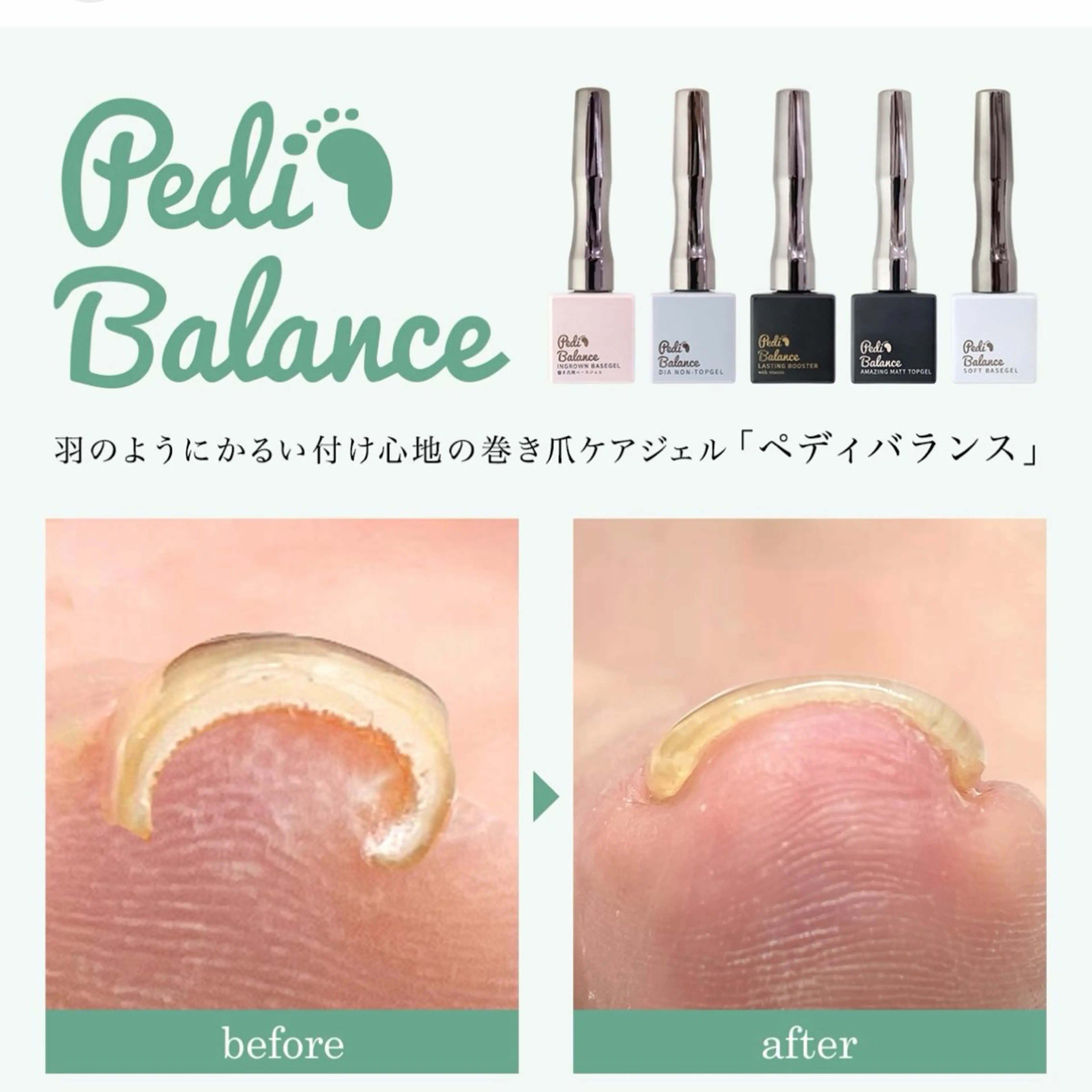 巻き爪ネイル👣の写真