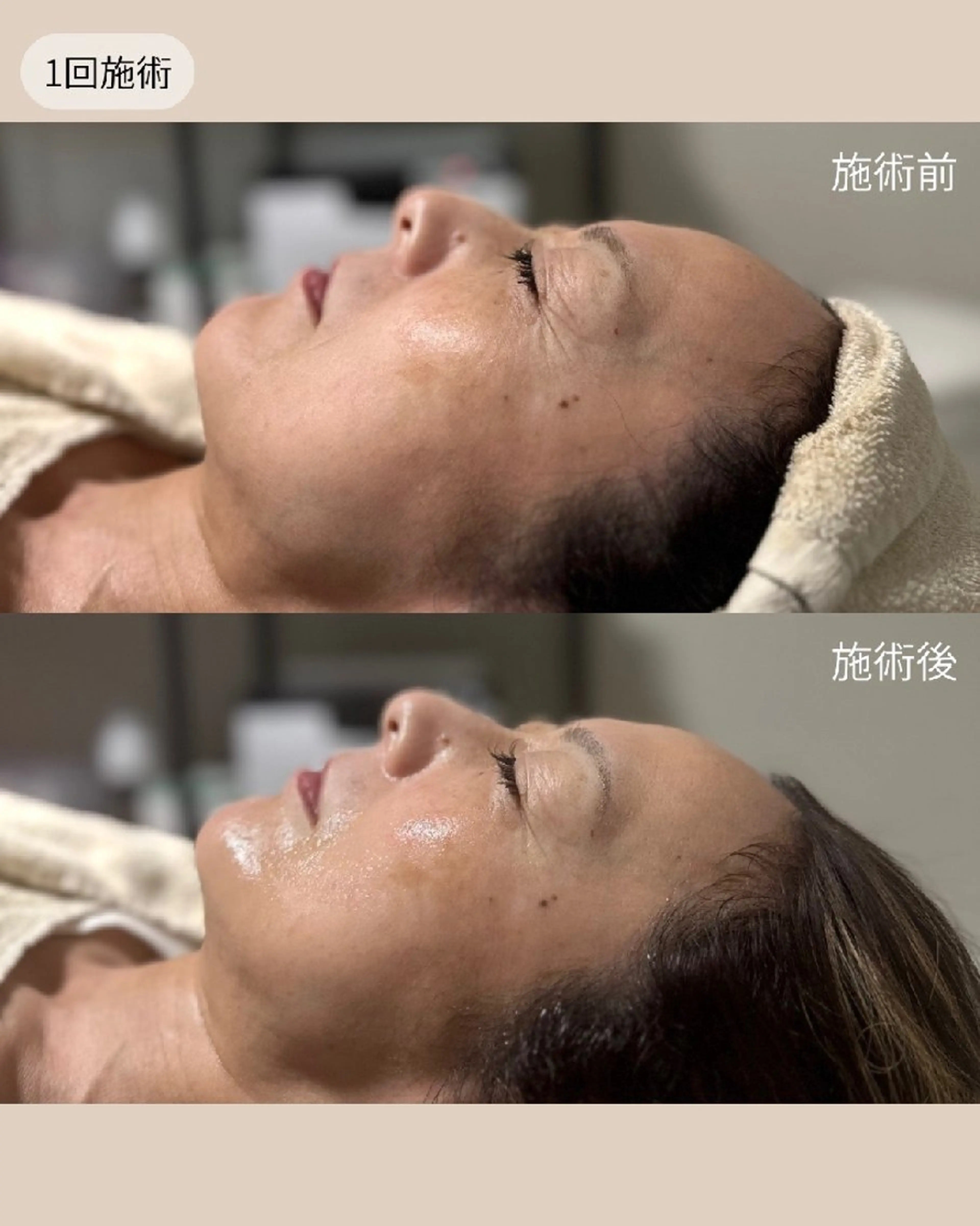 艶肌爆誕！ラミネーションピール🪞✨️の写真