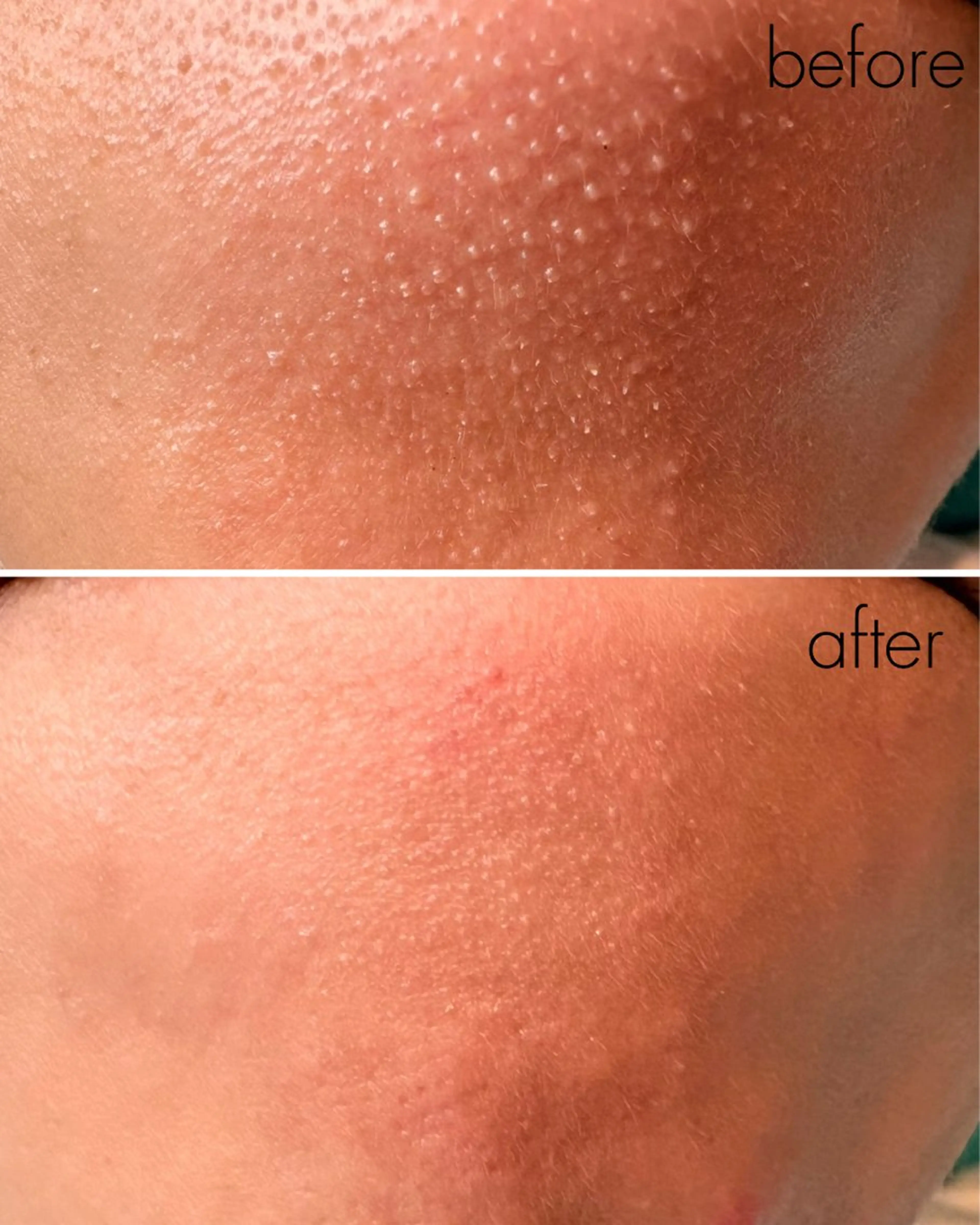 脱毛 蝶式糸除毛専門salon aco所属・糸除毛専門salon acoのエステ・リラクイメージ