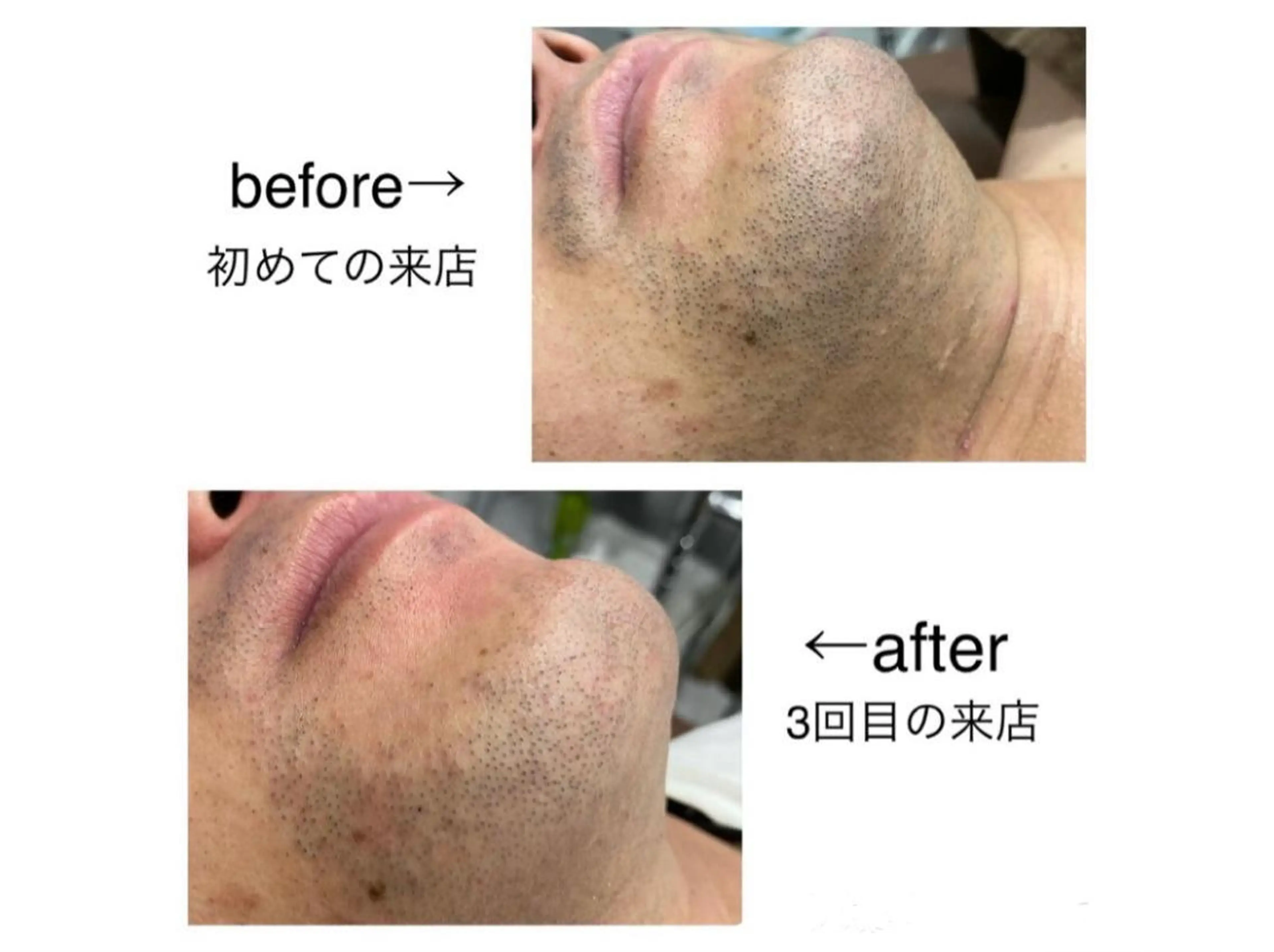 【メンズ】まずはお試し♪丸ごとヒゲ脱毛(首まわり込)×1回¥4,500→¥1,500の写真