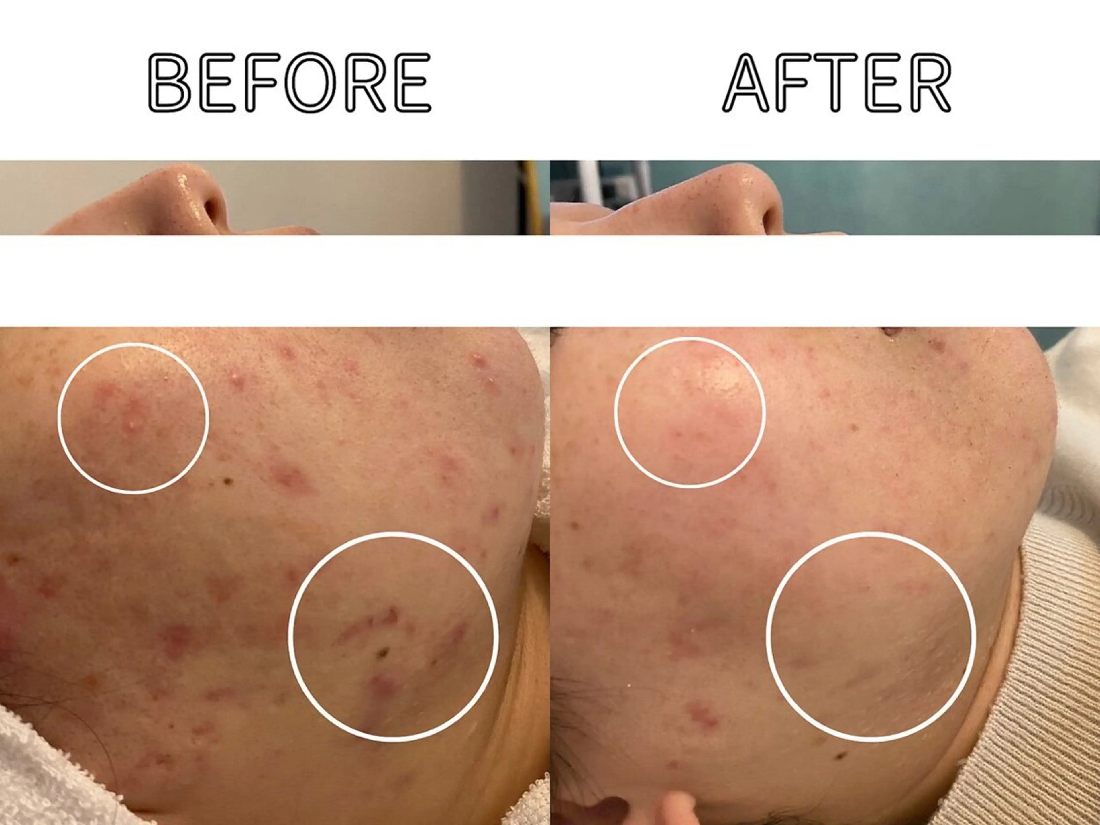 ハーブピーリング LIME池袋東口のエステ・リラクイメージ