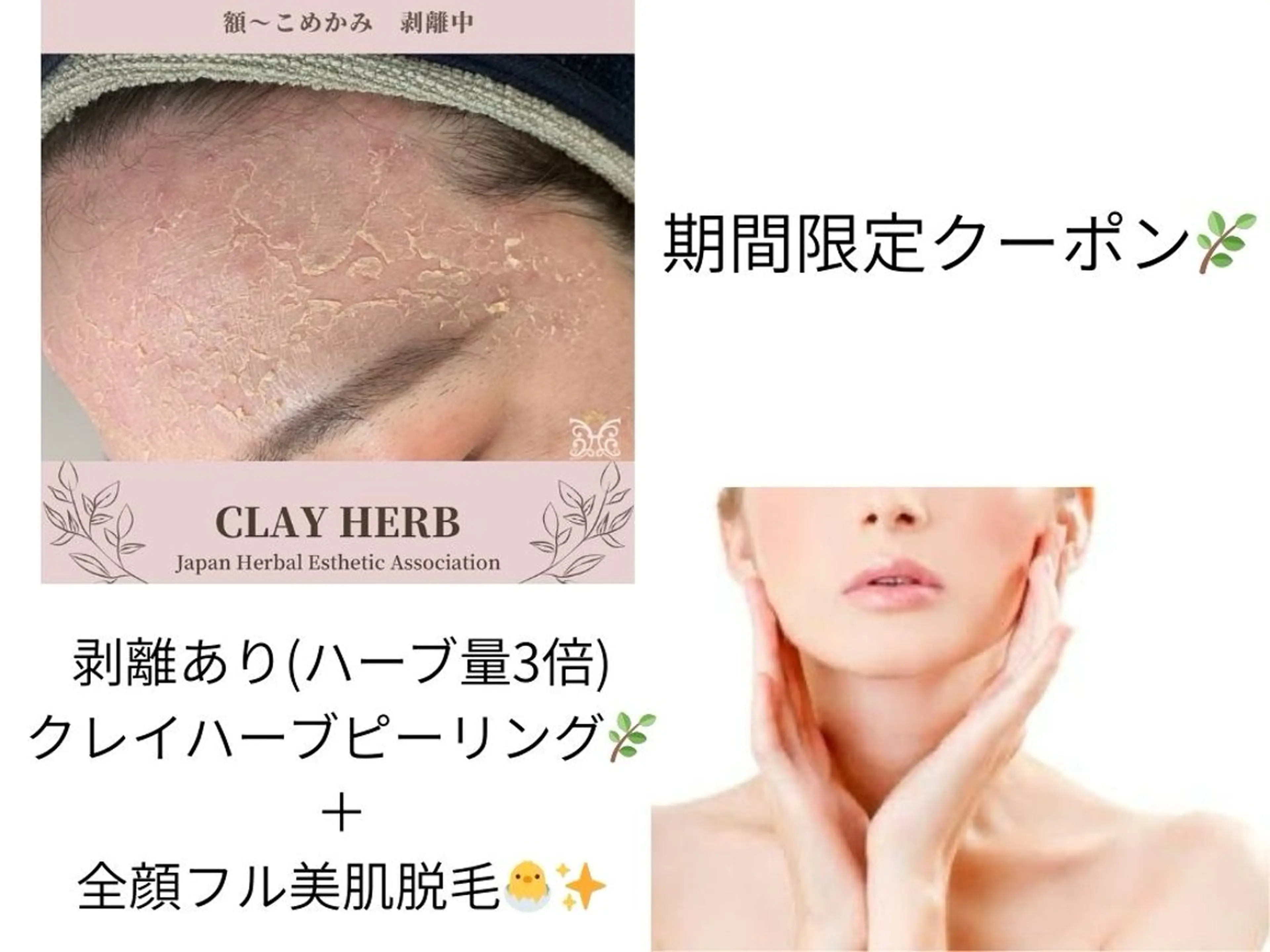 【9月限定】顔脱毛＋剥離ありクレイハーブピーリング　30,000円→26,000円の写真