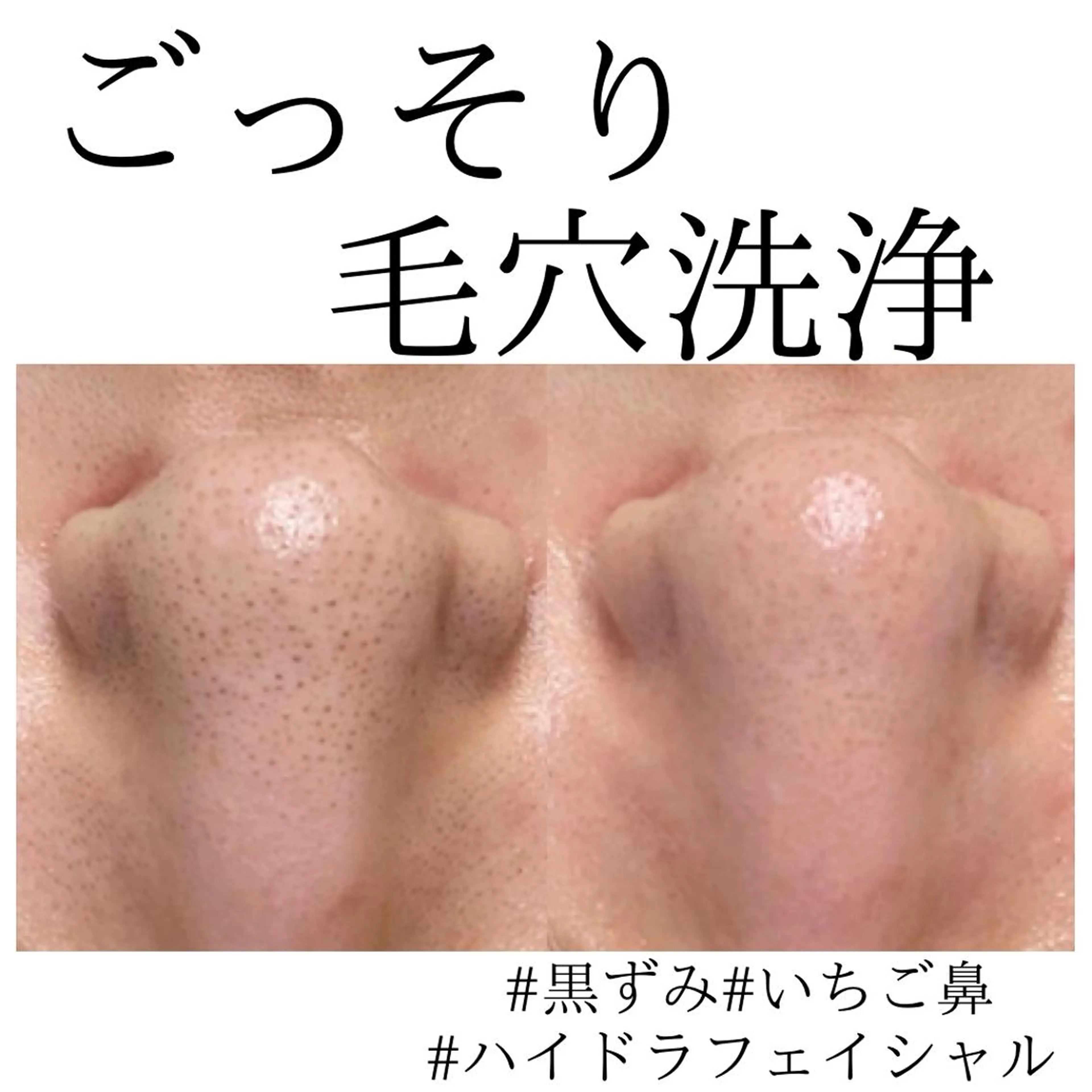 【いちご鼻.皮脂.ニキビ】大人気ハイドラ！水素毛穴洗浄＋美容液導入+高保湿パック🤍毛穴汚れスッキリ✨の写真