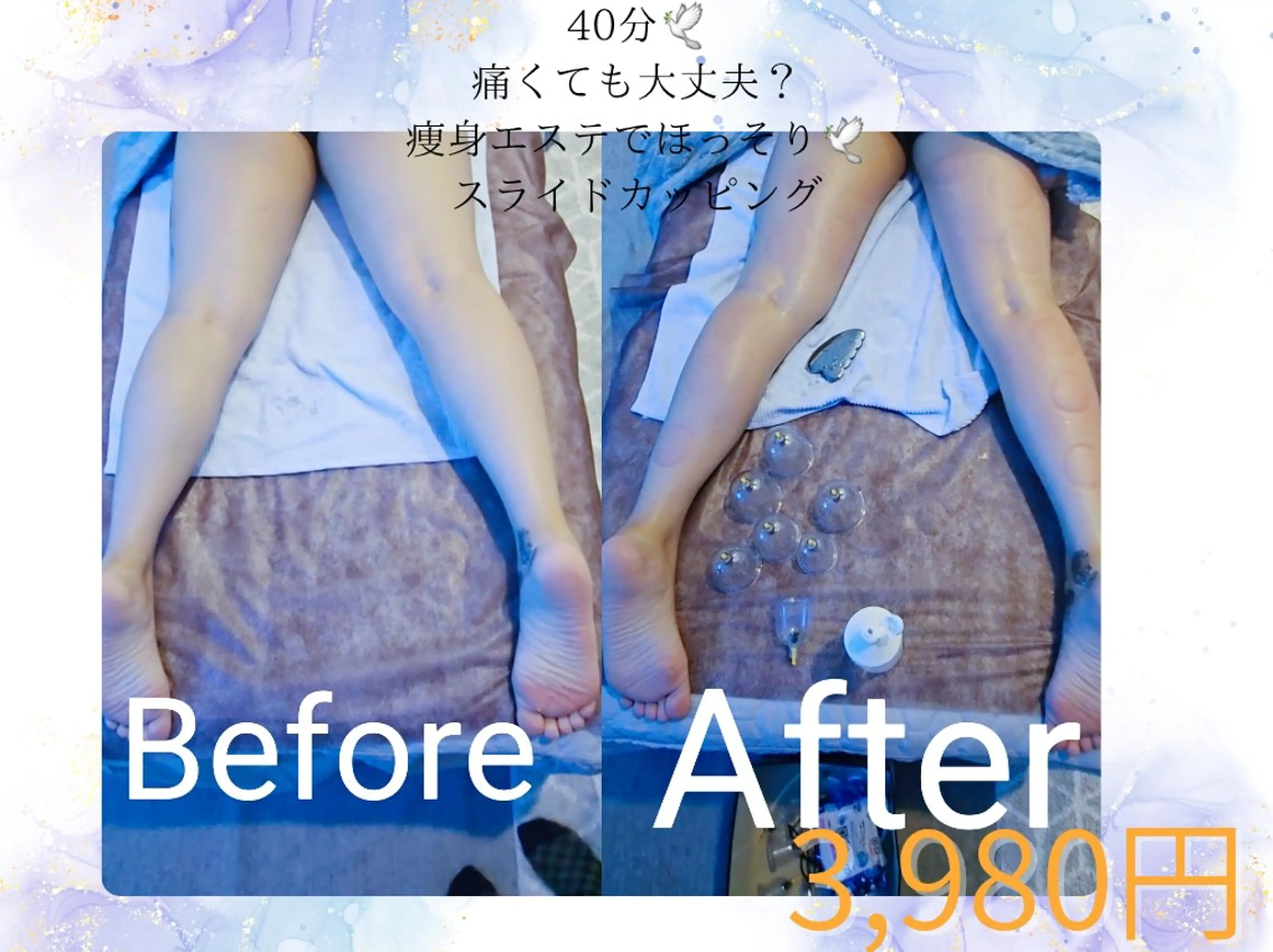 🌸痛みに強い方、ダイエットを真剣にしたい方🎶痩身スライドカッピング🕊40分＋10分の写真