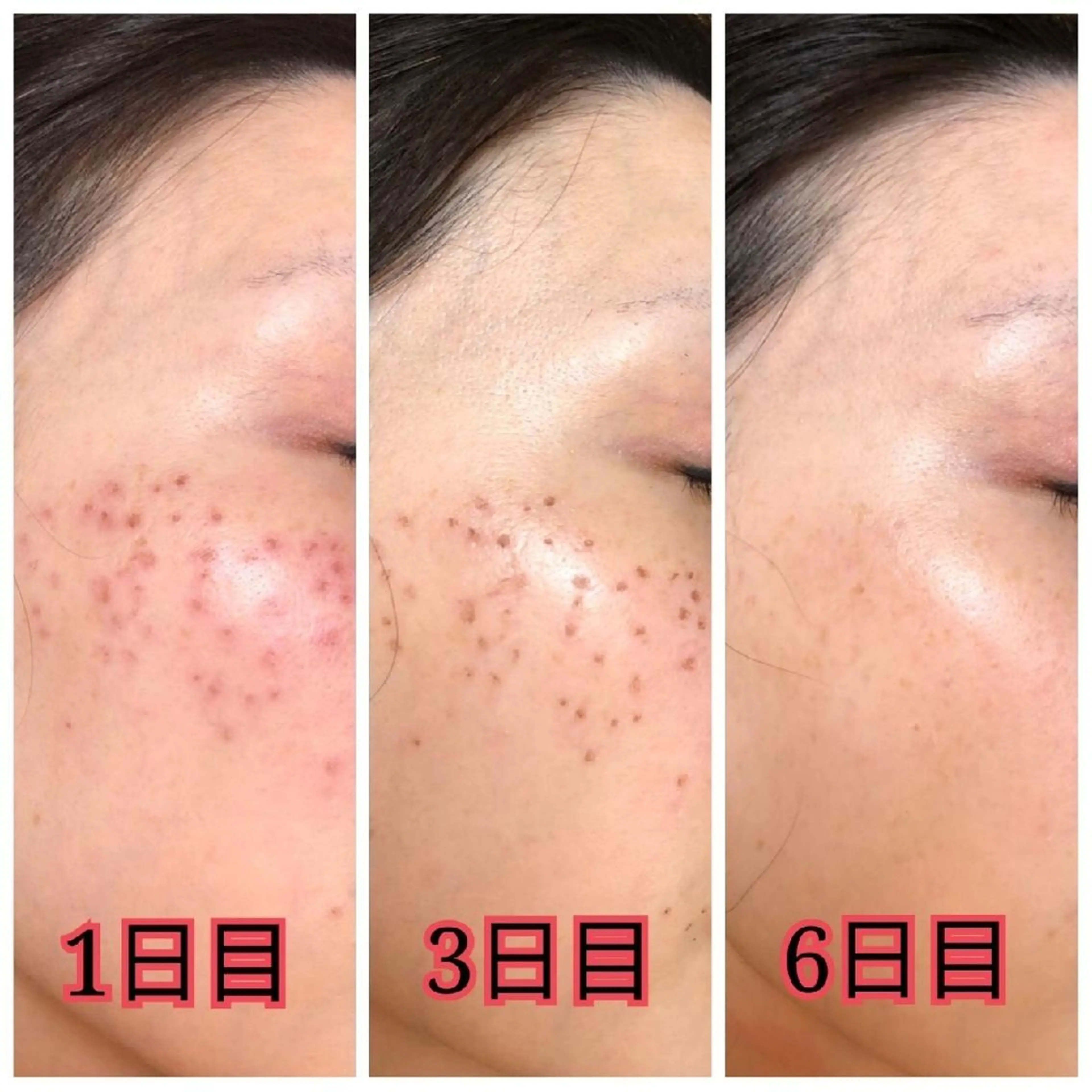 新メニュー☆シミケアフェイシャル💆の写真