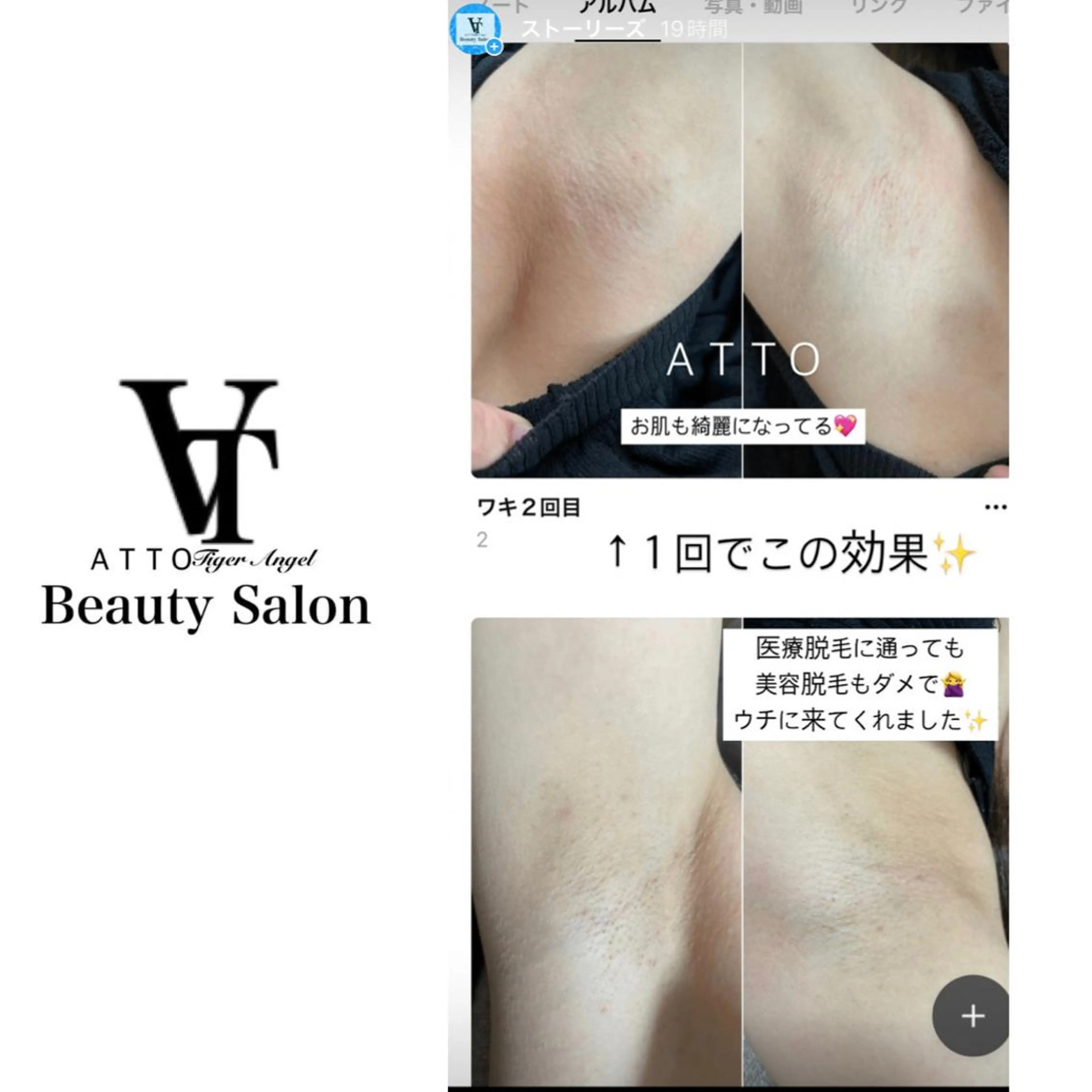 大人気メニュー♪ワキ脱毛！！一回から効果実感！の写真