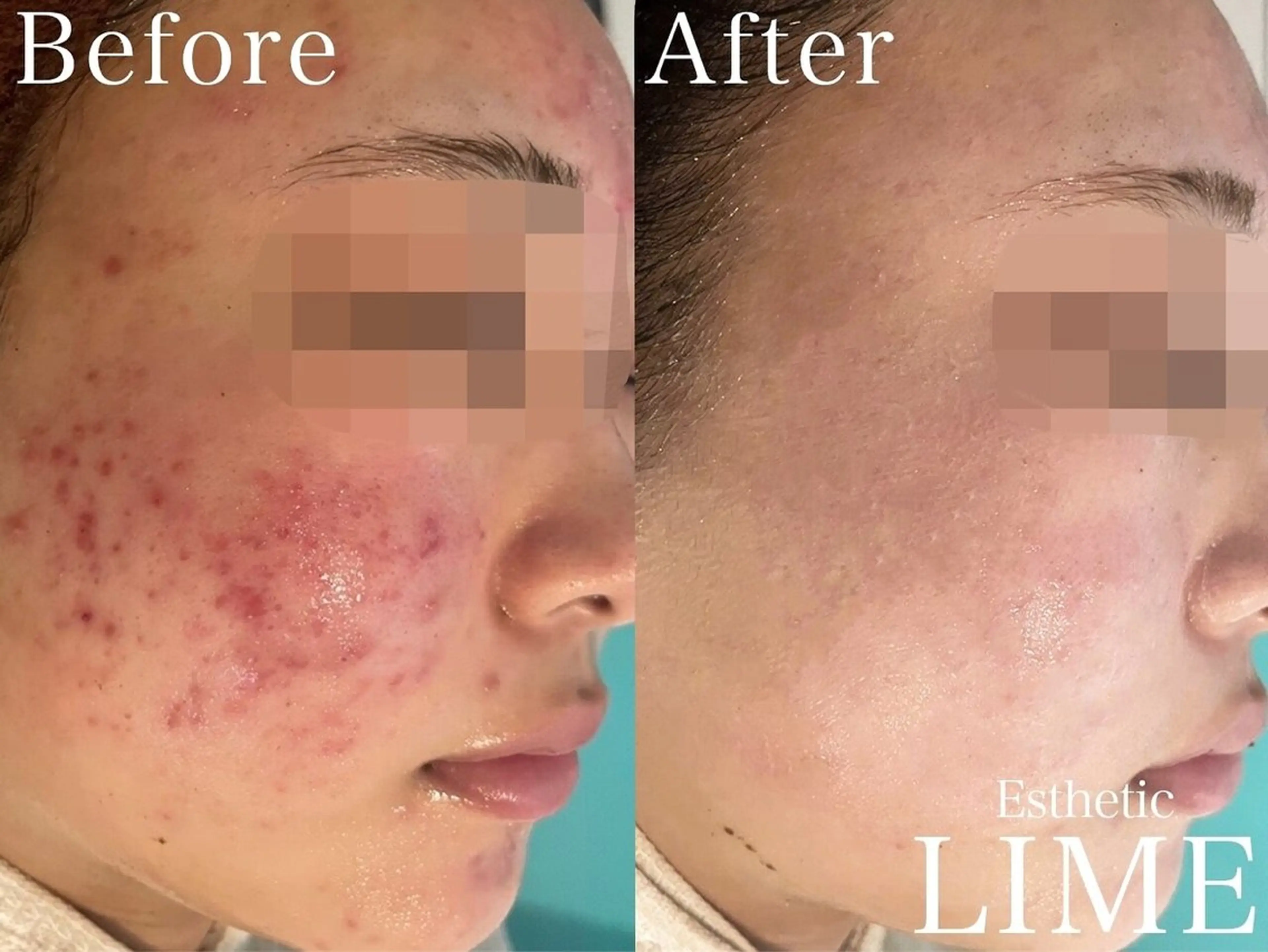 ハーブピーリング LIME池袋東口のエステ・リラクイメージ