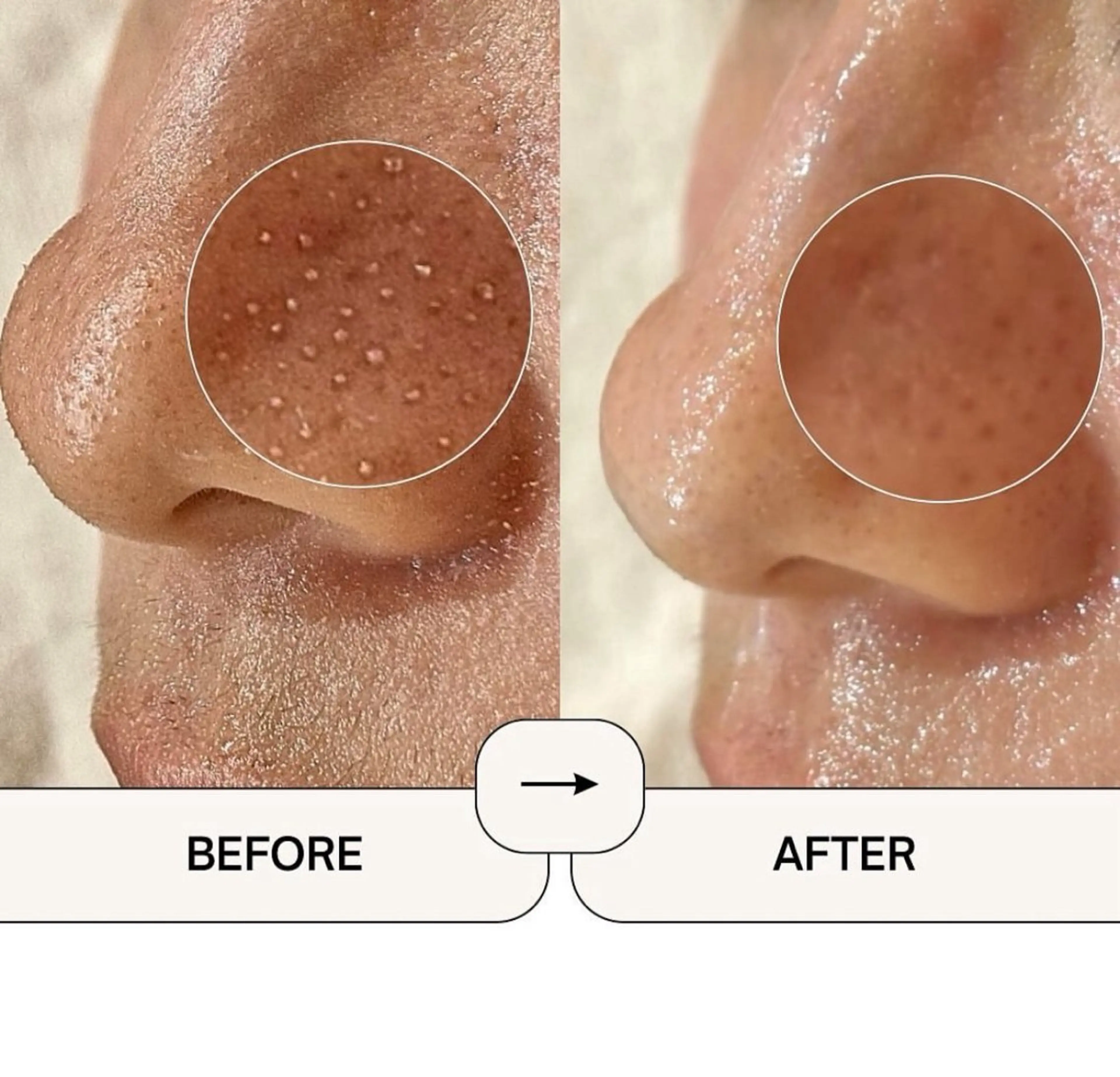 【1日3名限定】モニター価格🉐韓国式毛穴洗浄アクアピール🫧🎀黒ずみ／いちご鼻／角栓汚れ¥5,500→3,400の写真