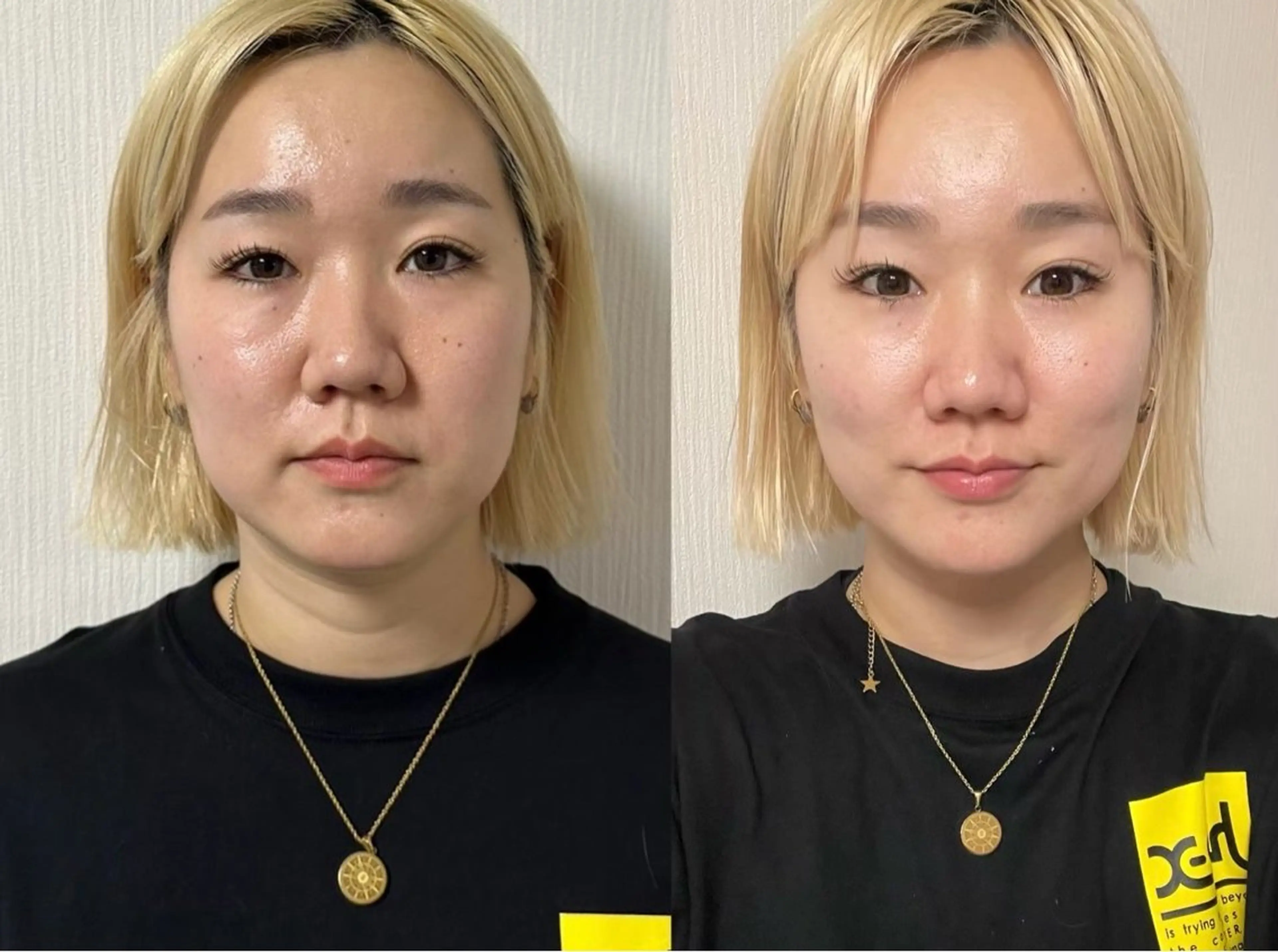 【最強小顔！美肌エイジングケア】SNSで話題沸騰✨テラボーラーでお顔の筋トレ&幹細胞美容液&毛穴引き締め美白パックの写真