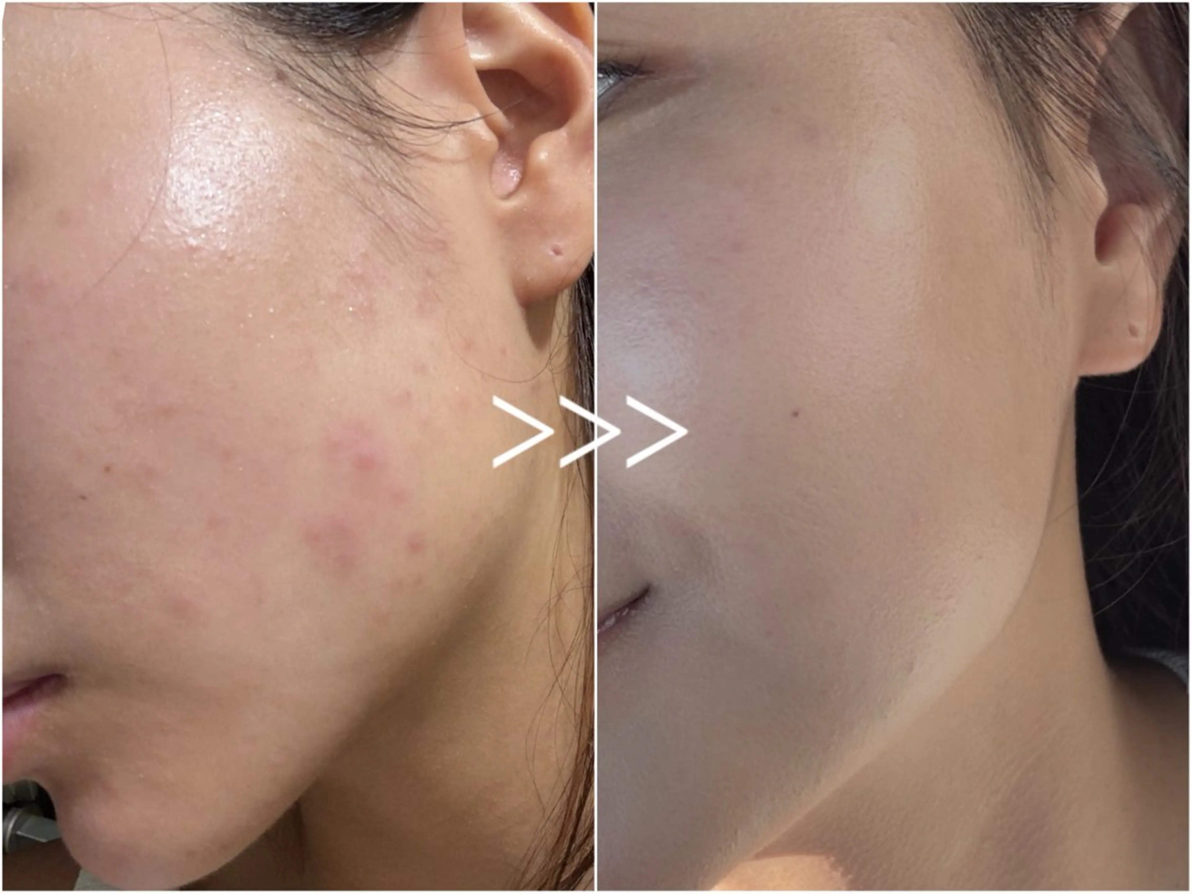 beauty salon Fee所属・毛穴開き黒ずみ ニキビ特化サロン◎のエステ・リラクイメージ