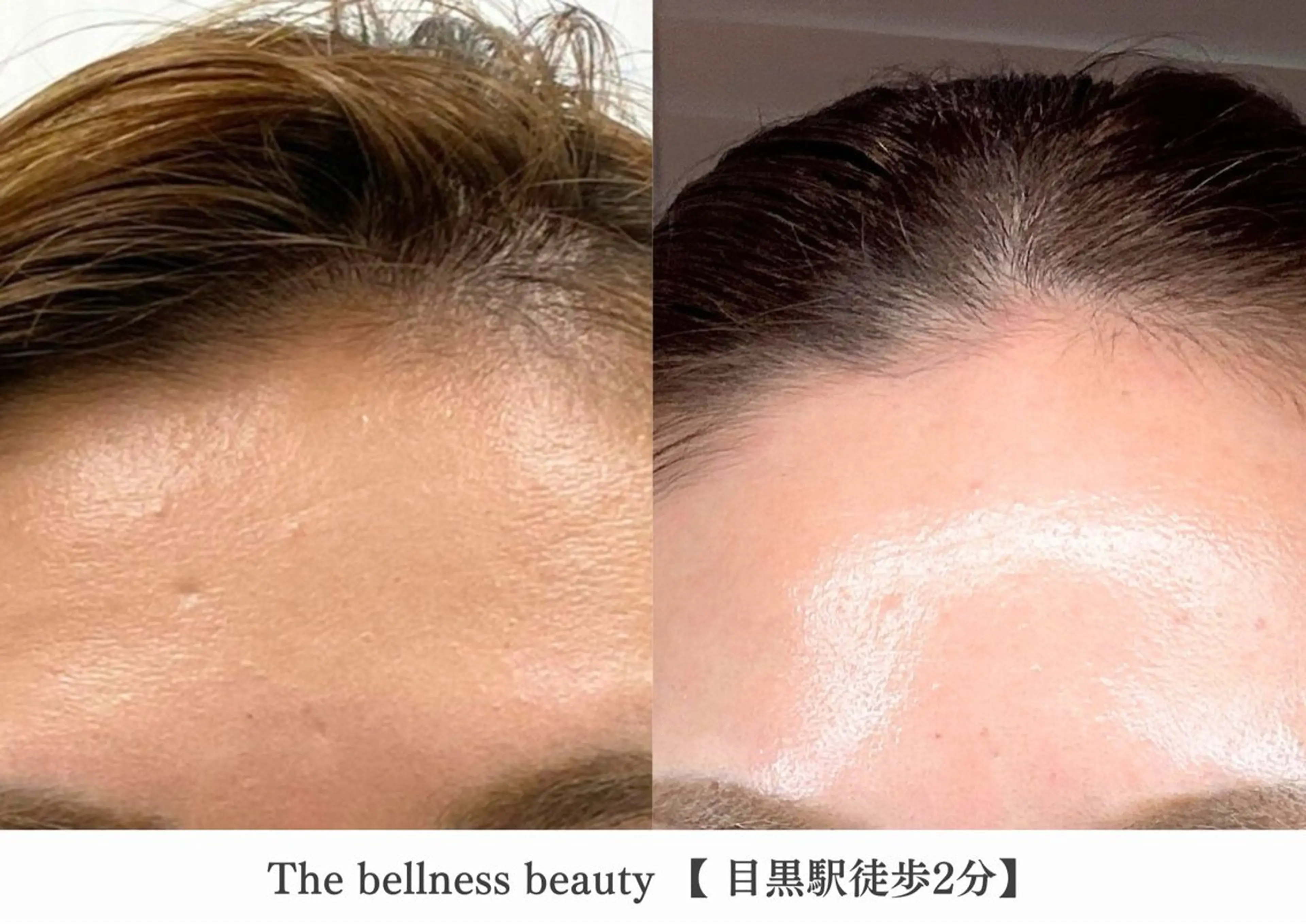 エステ 《毛穴レス美肌》ザ・ ベルネス 目黒駅2分のエステ・リラクイメージ