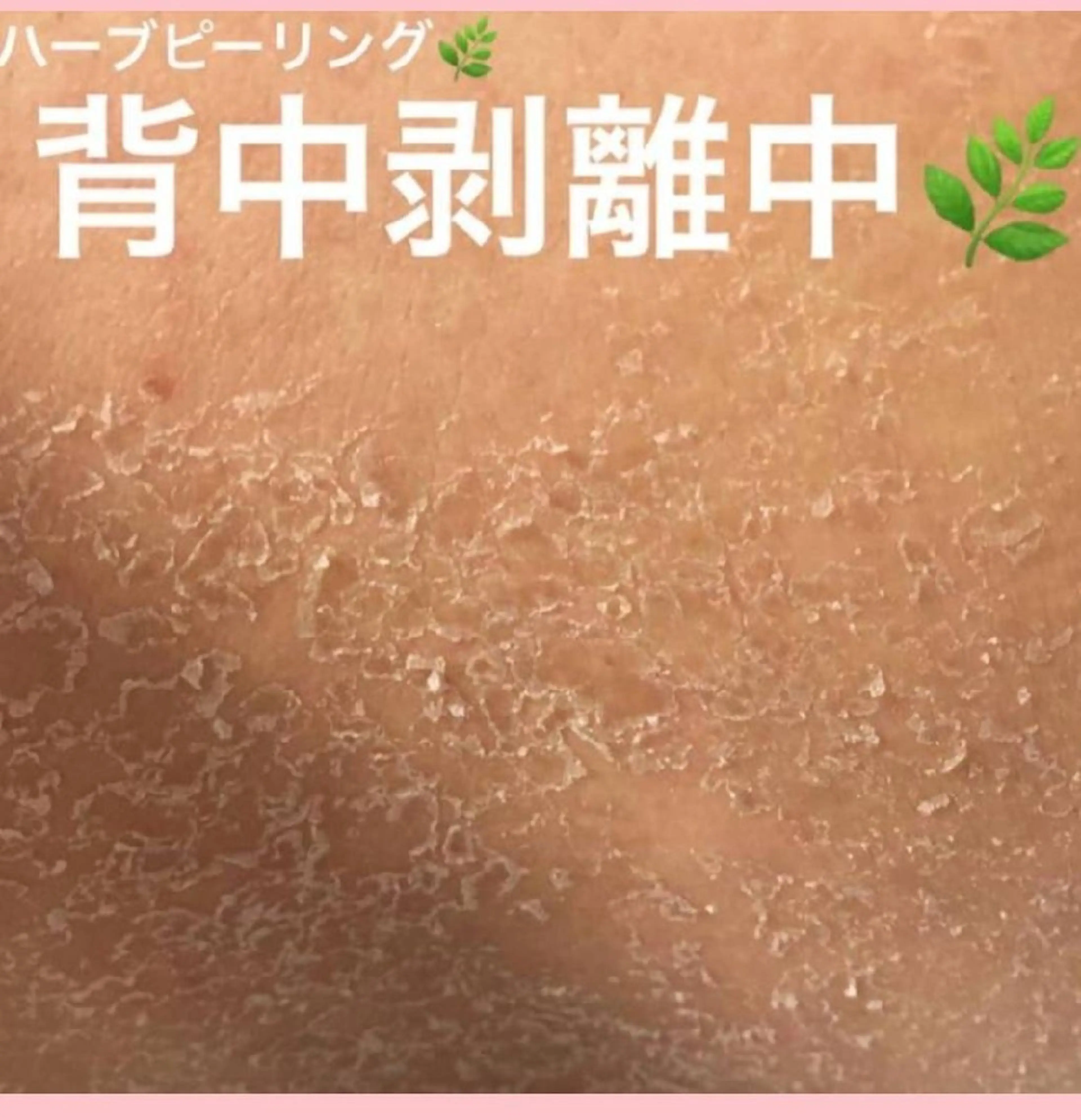 ミニモ限定‼️平日限定‼️モニター🌿Bodyハーブピーリング4980円🌿剥離あり🌿午後5時までの写真