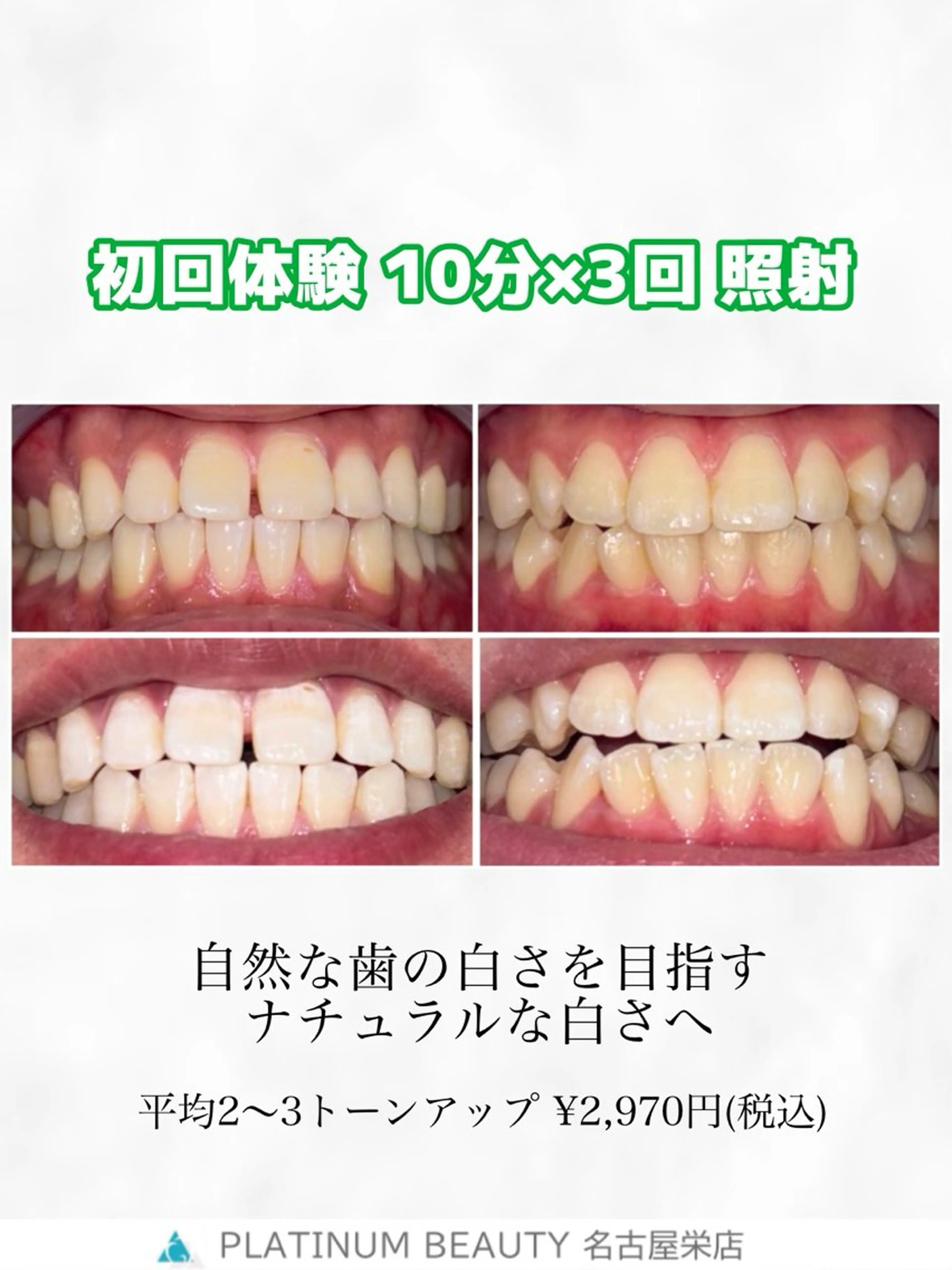 【平均2​〜​3トーンアップ】　SNS映え◎お試しセルフホワイトニング✨〈15分×2回〉の写真