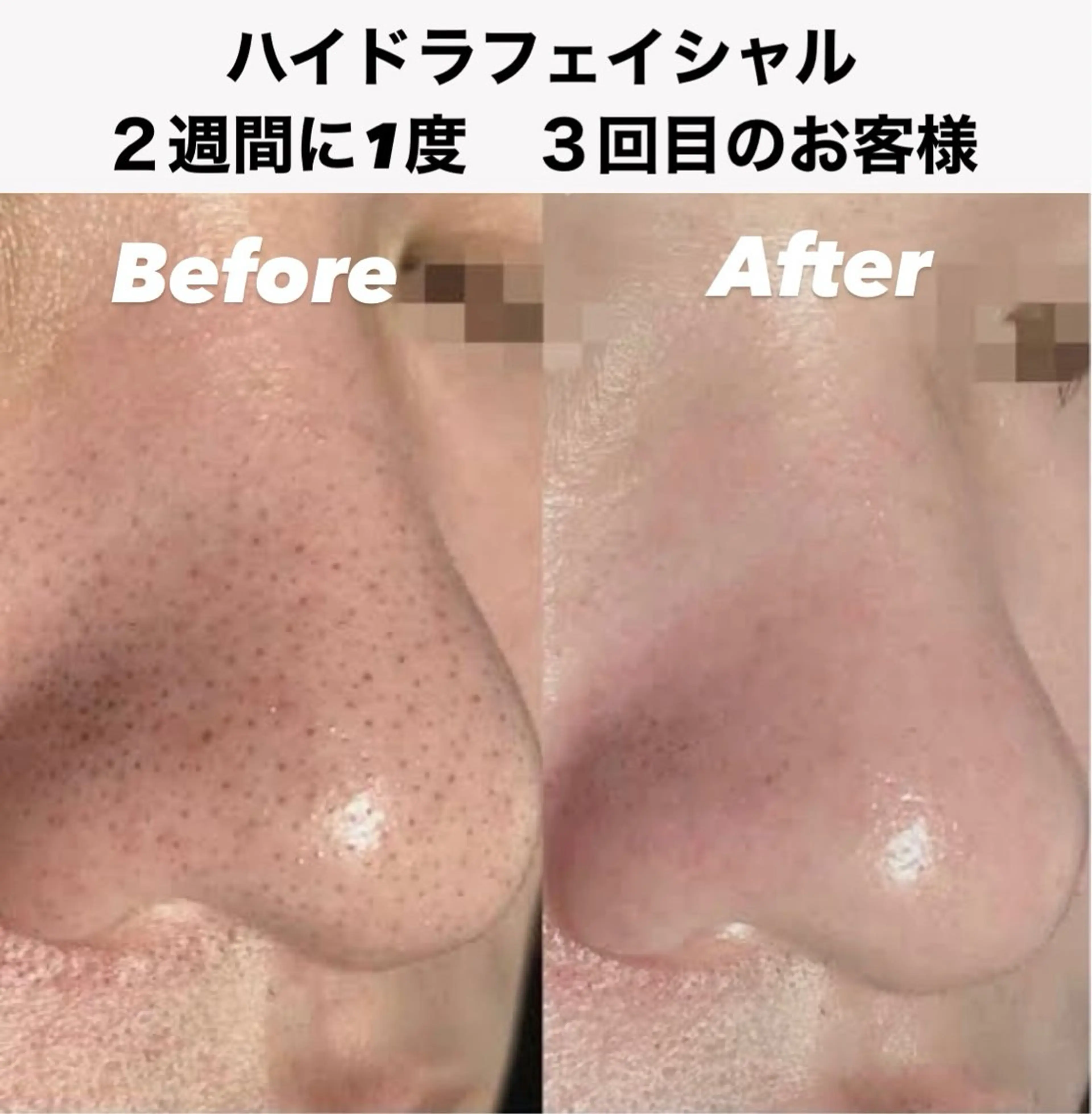 毛穴洗浄（ハイドラフェイシャル）は2週間に1度の頻度でご来店
