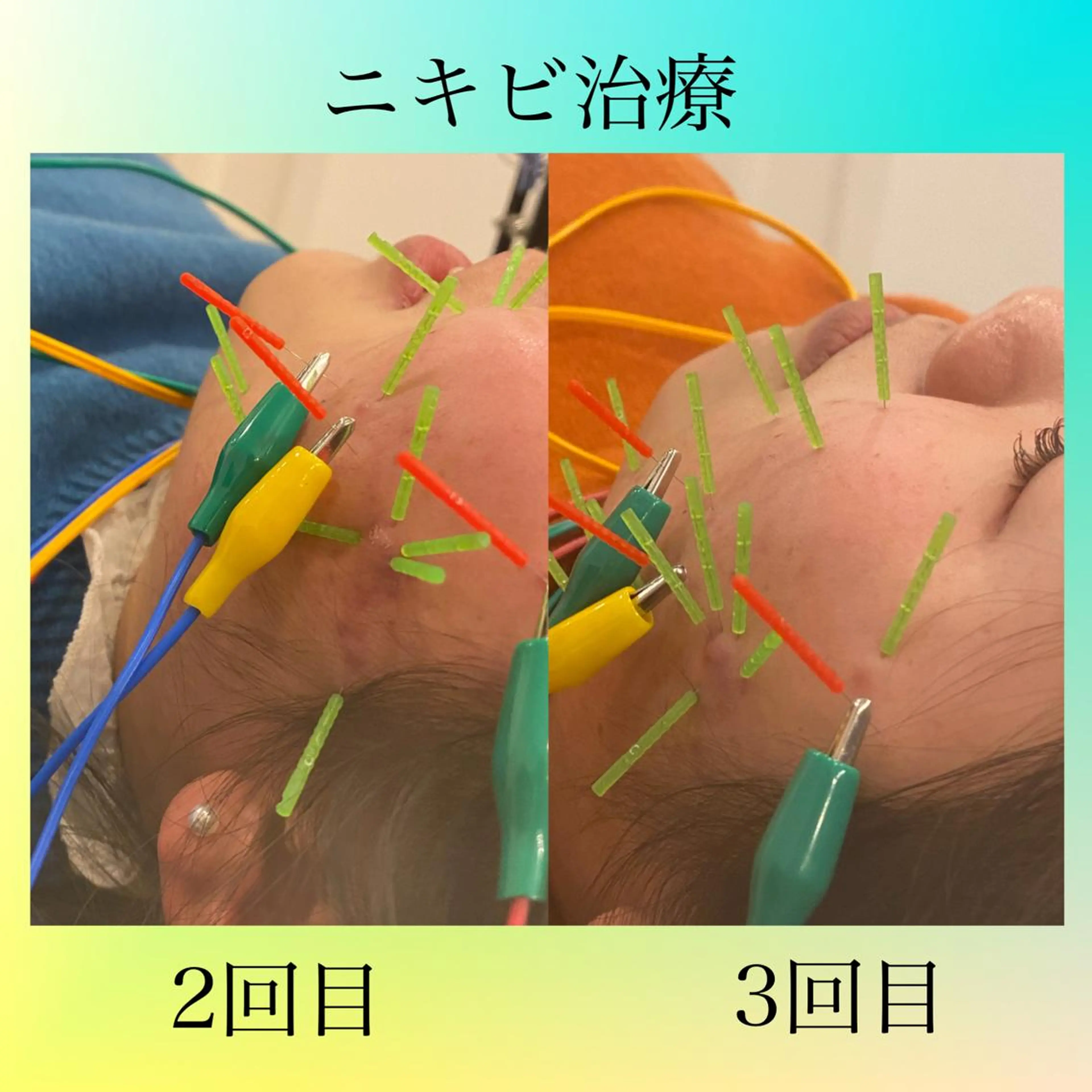 エステ リラク 美容鍼灸Solana所属・小櫻 唯のエステ・リラクイメージ