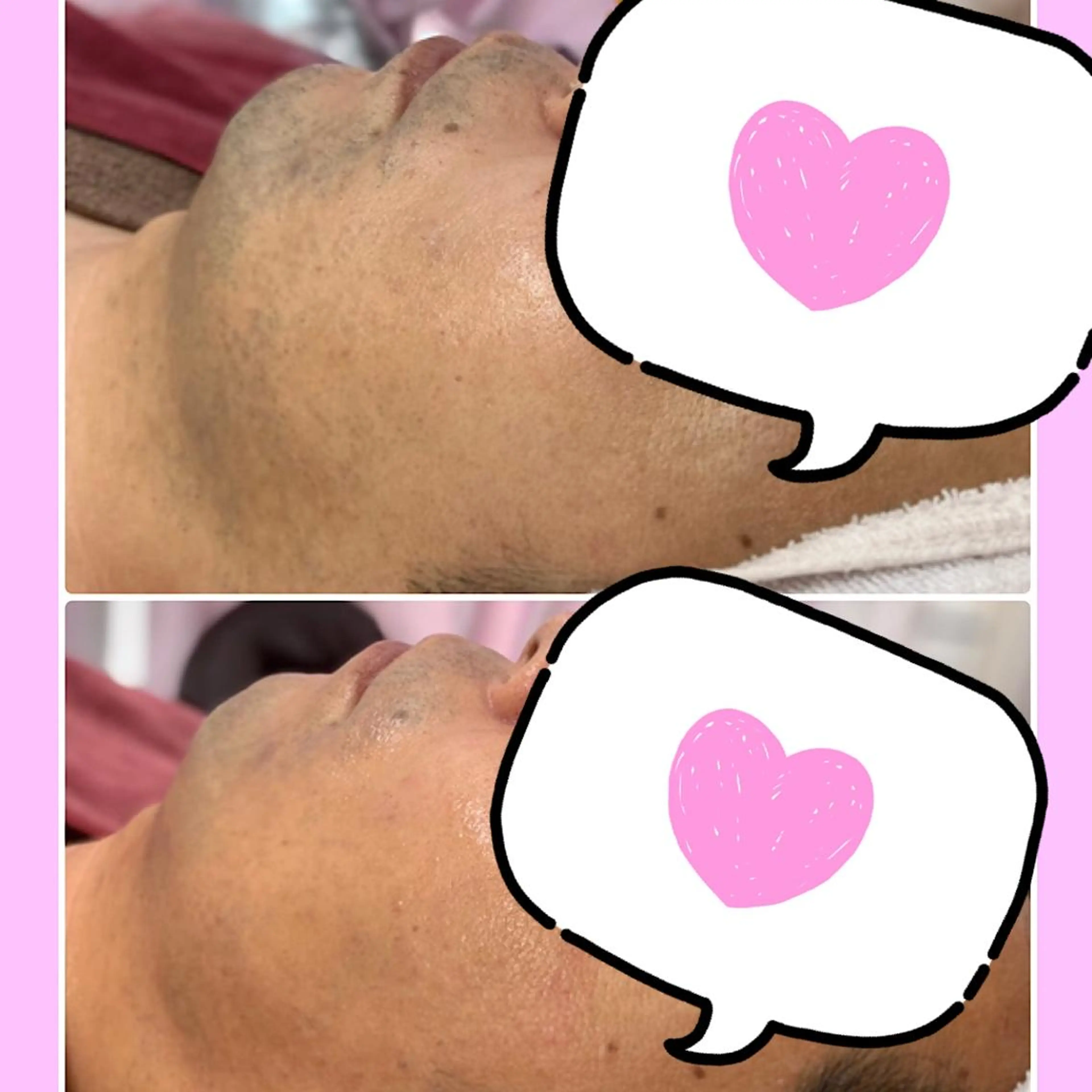 【メンズ脱毛】ひげ脱毛　2週間ごとにできる脱毛  ひげの箇所のみの脱毛です　ひげをそってきてくださいの写真