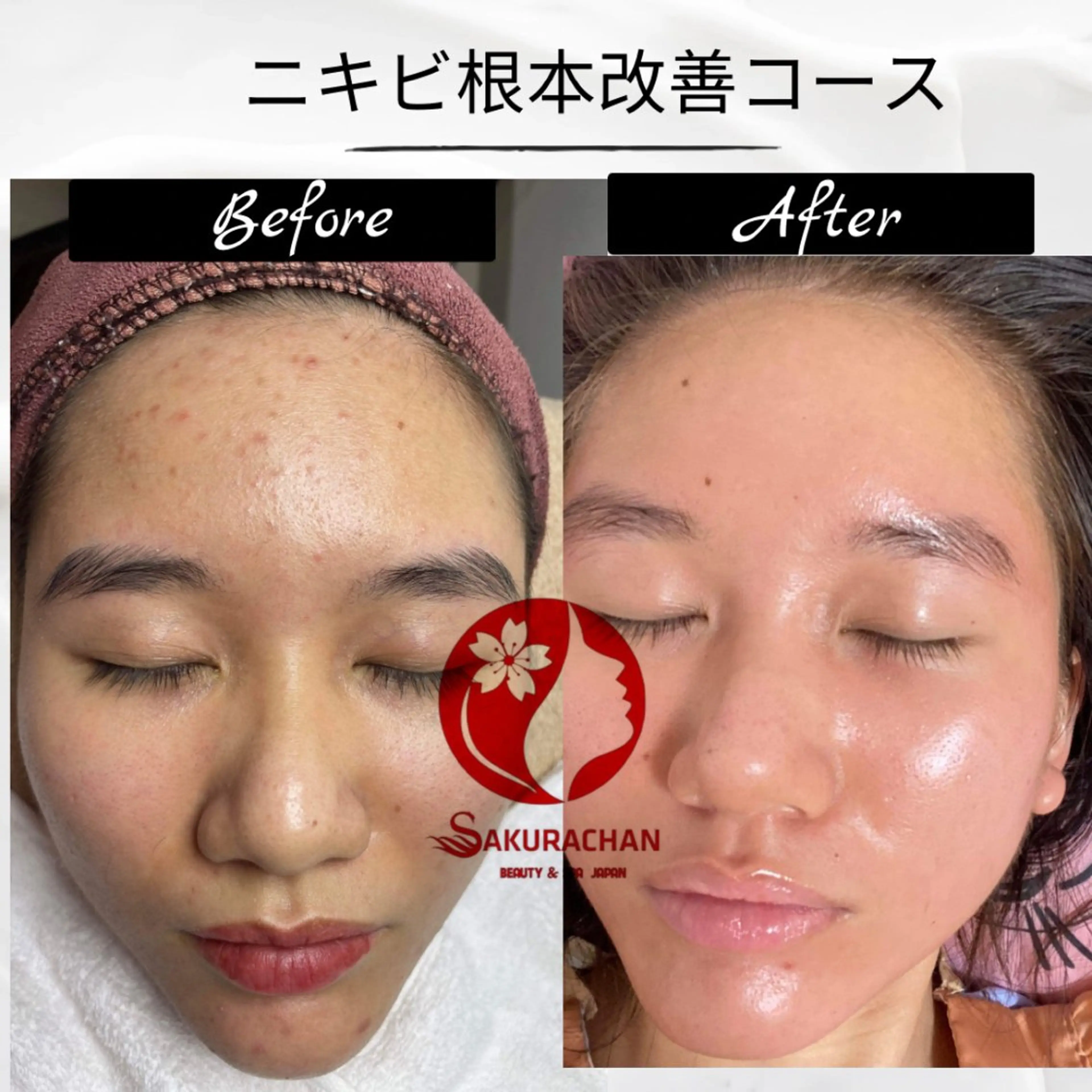 エステ ニキビ、痩身、脱毛、 サクラチャンスパのエステ・リラクイメージ