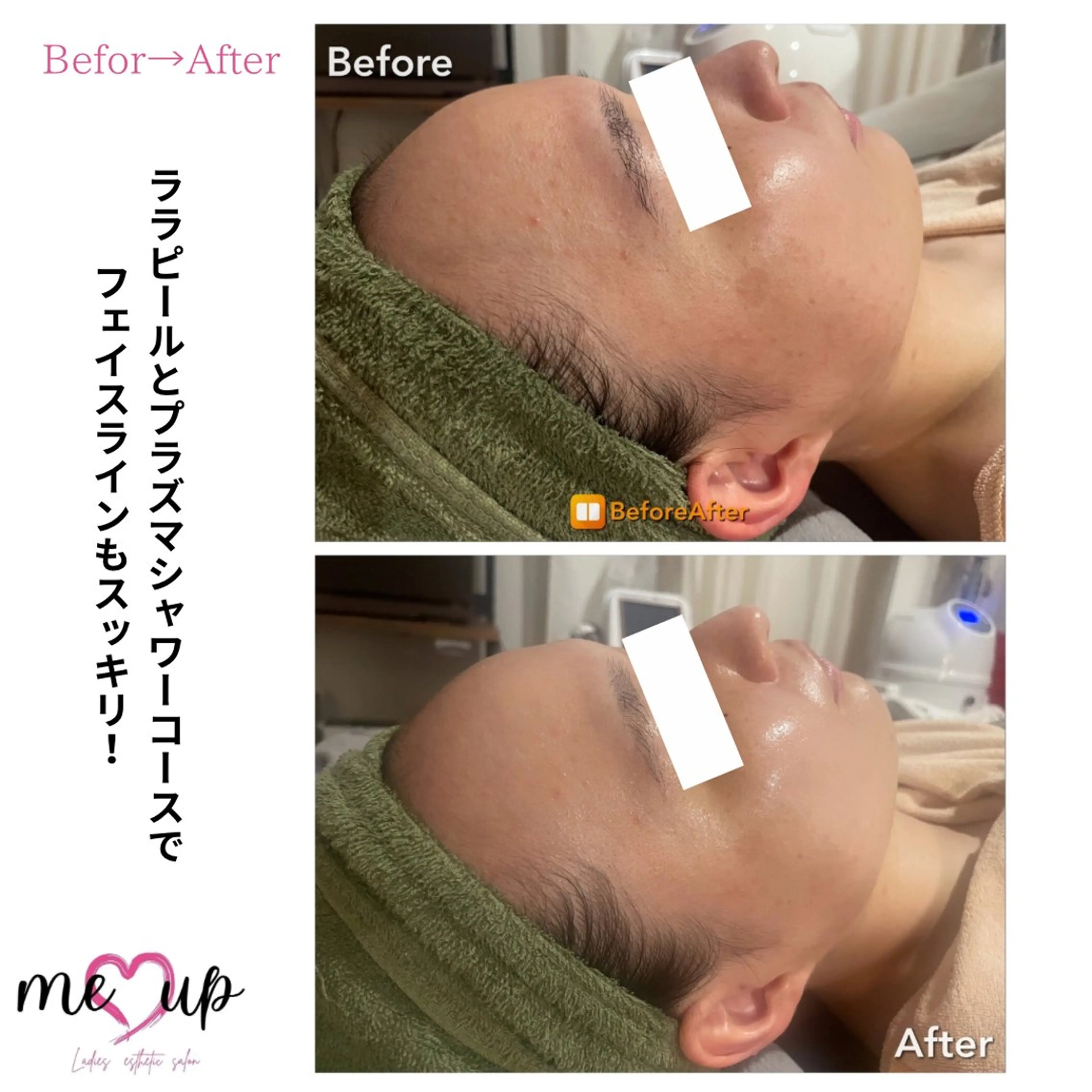 エステ Meupニキビ専門店 背中/ハーブ/ララのその他イメージ