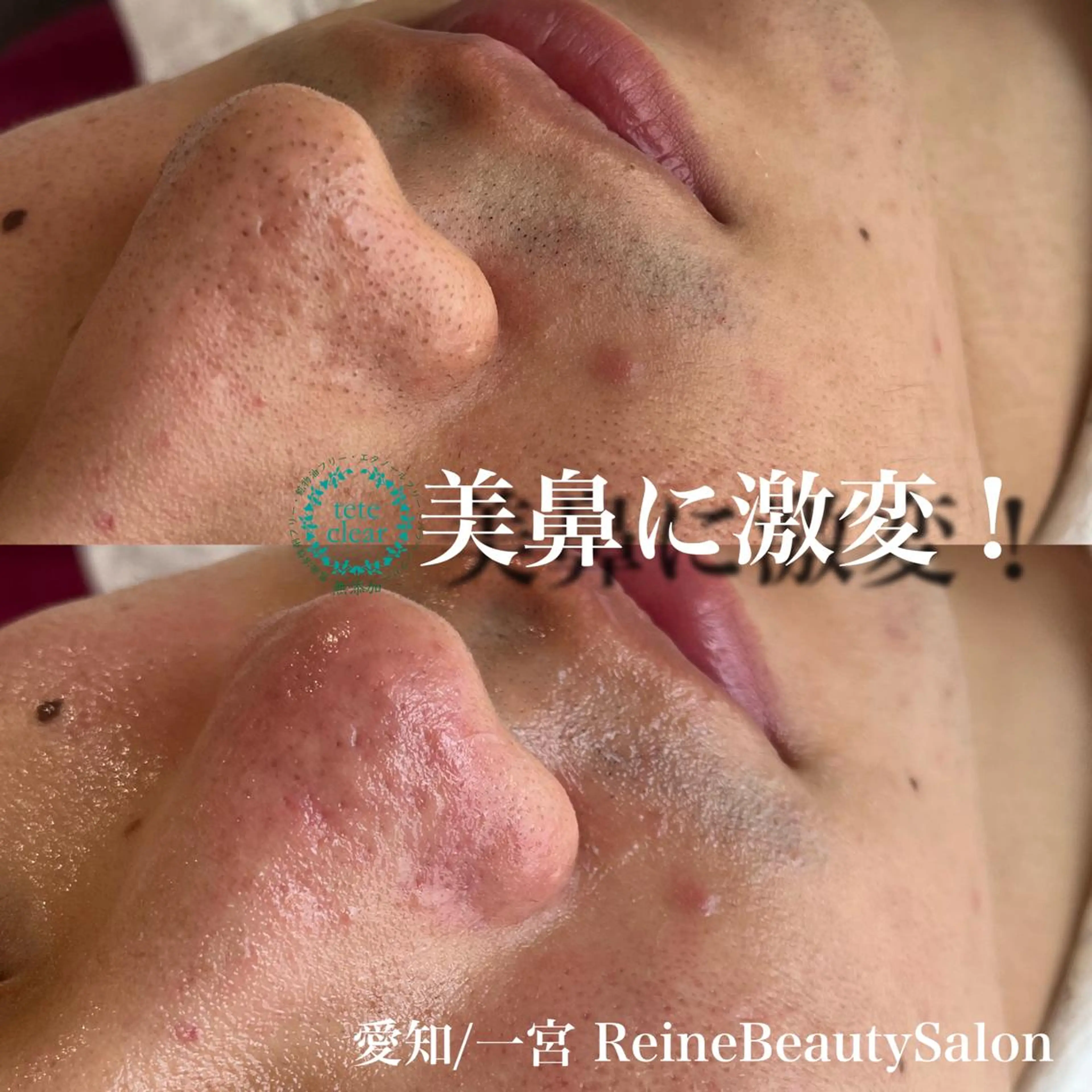 エステ Reine BeautySalon所属・毛穴/シミ肝斑/脱毛 横山梨里のエステ・リラクイメージ