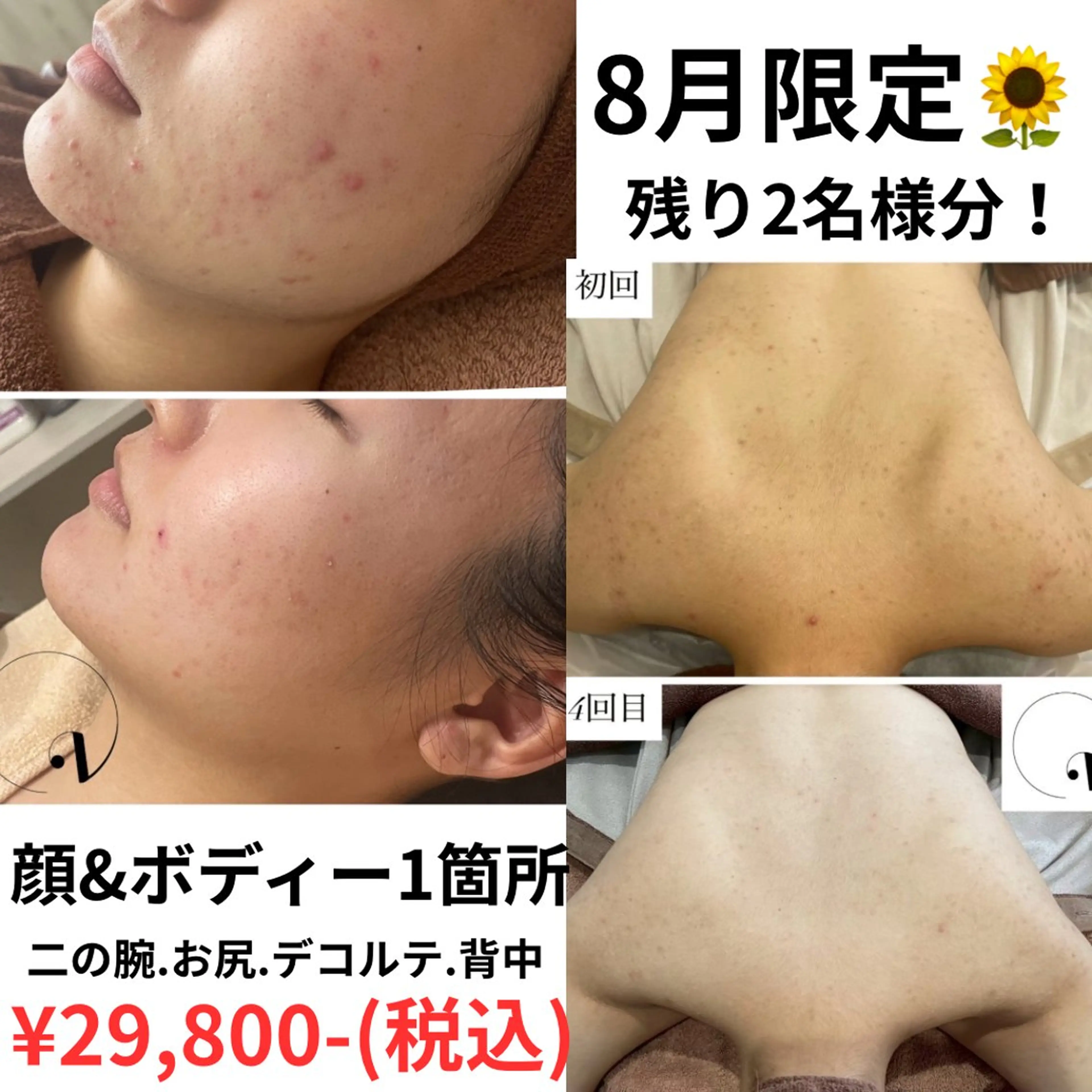 【8月☀️残2名様限定】お顔&ボディー1箇所！剥離有りハーブピーリングでツルツルボディに🌻💛の写真