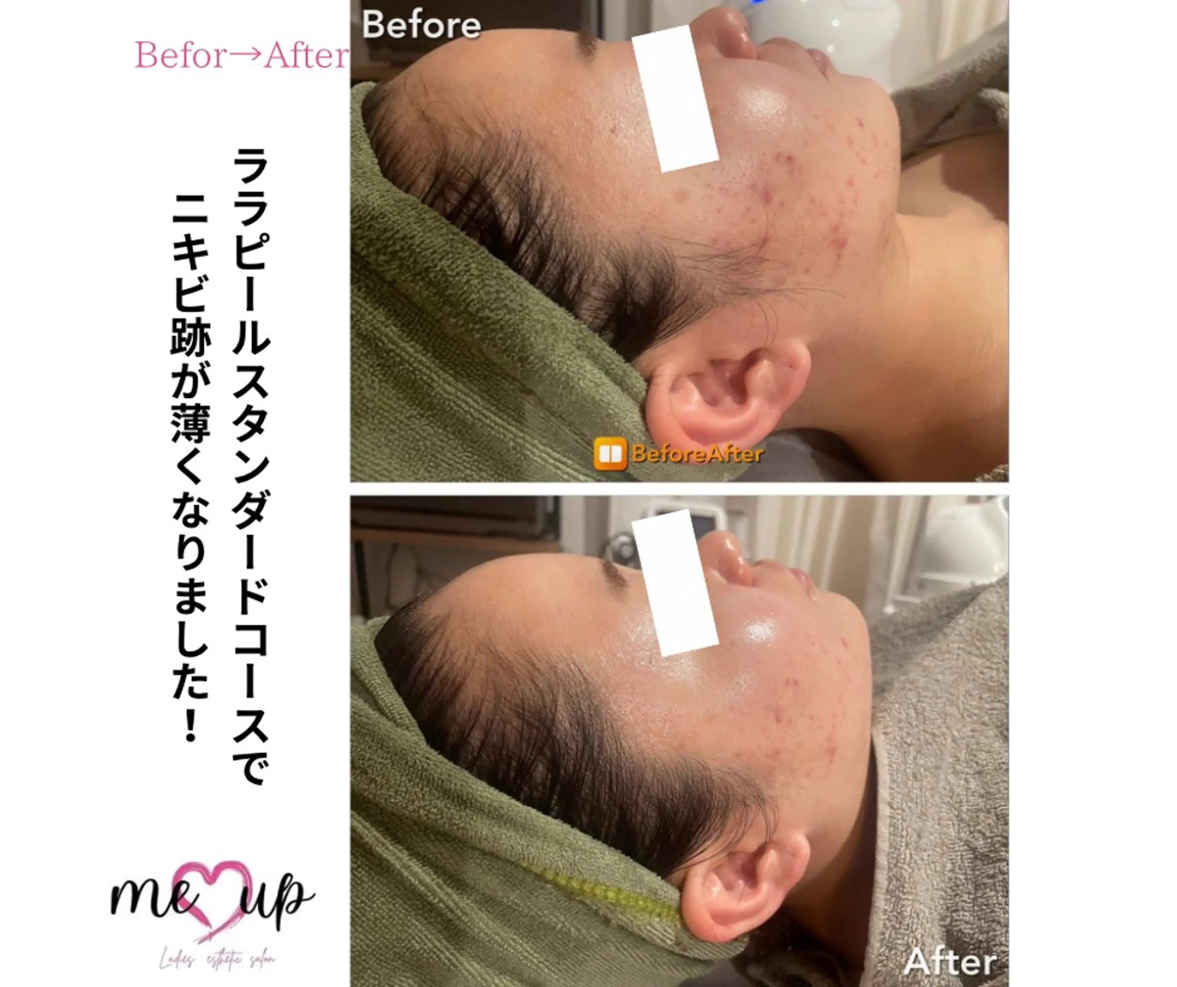 エステ Meupニキビ専門店 背中/ハーブ/ララのその他イメージ