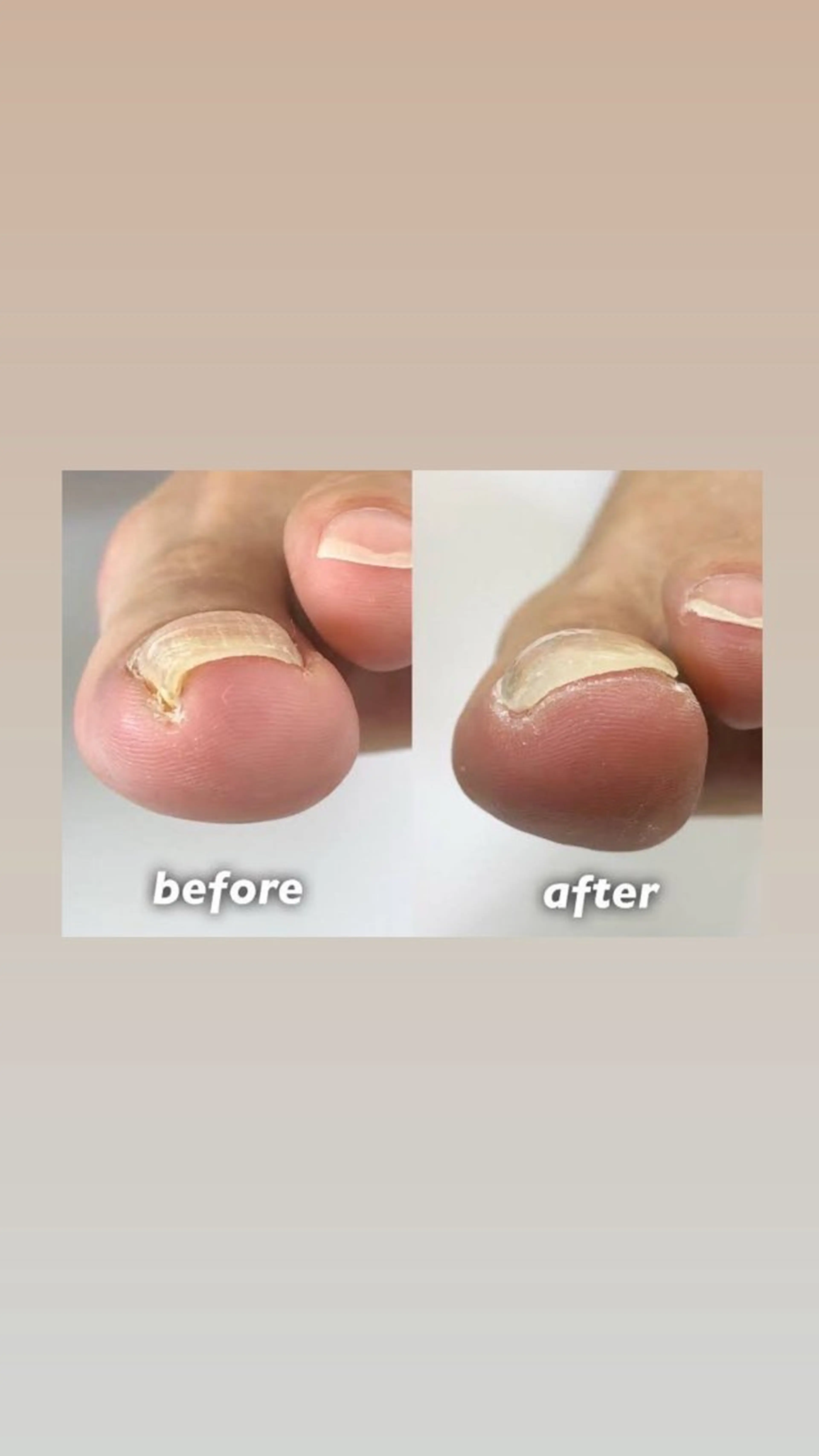 🦶【片親指】巻き爪矯正🦶の写真